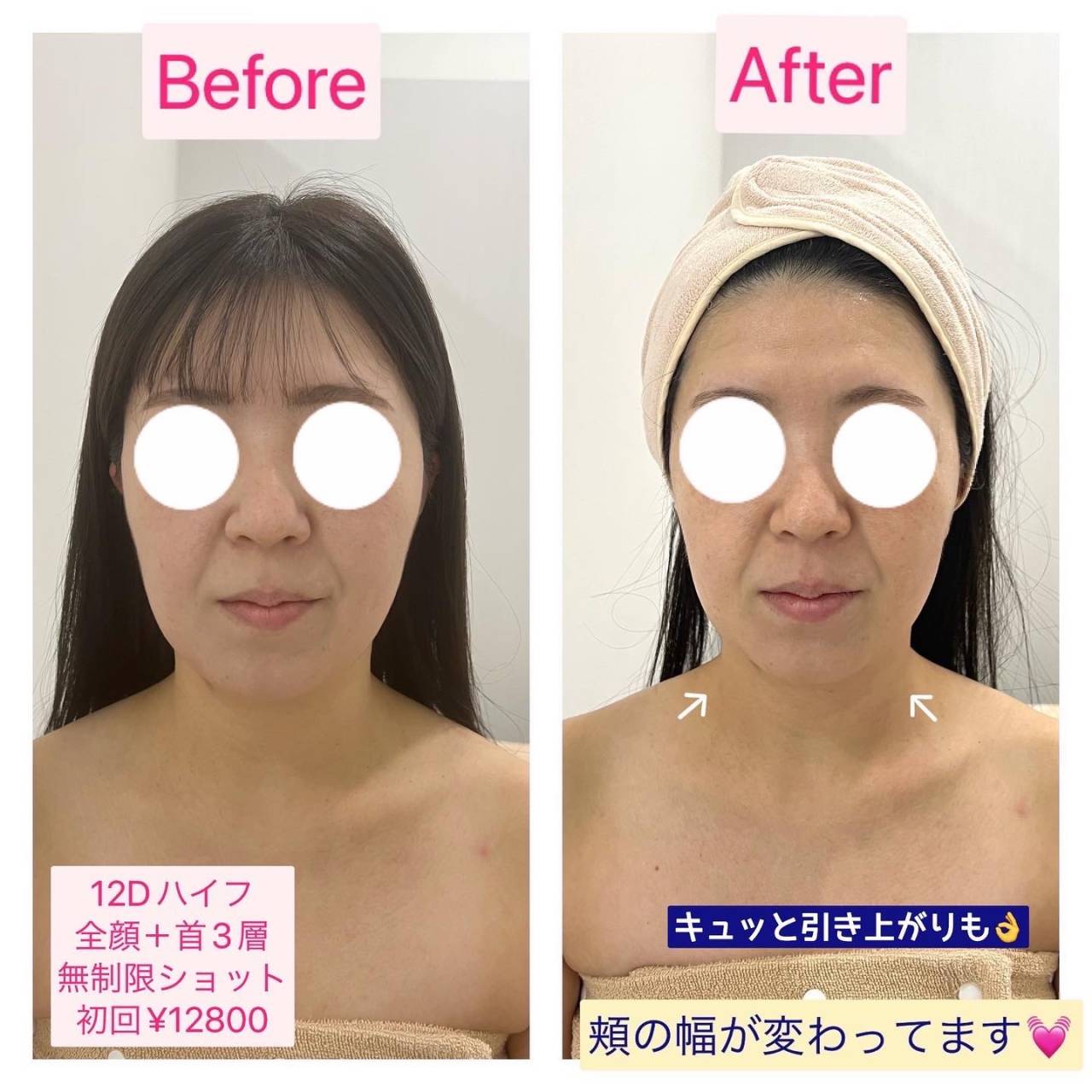 12Dハイフ（HIFU）でたるみ改善リフトアップ・小顔ハイフ｜尼崎エステRinda Beauty Salonリンダビューティーサロン | ブログ |  尼崎のエステサロンならRinda Beauty Salon