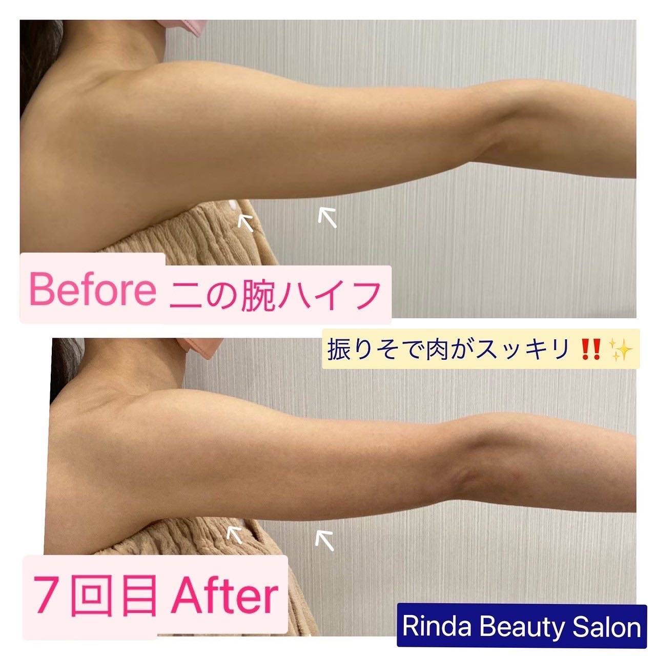 １２Dハイフ（HIFU）で集中、二の腕痩せしたい方は兵庫県（尼崎）エステサロンRinda Beauty Salonリンダビューティーサロンで改善☆ |  ブログ | 尼崎のエステサロンならRinda Beauty Salon