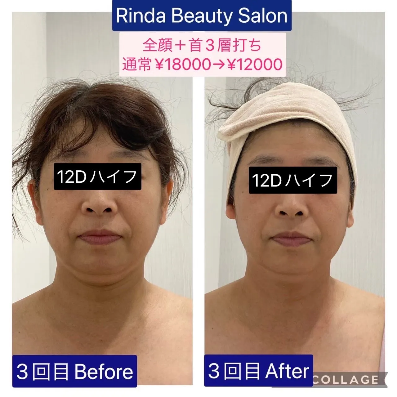 たるみが気になる方は小顔ハイフが人気の兵庫県（尼崎）エステサロンRinda Beauty Salonリンダビューティーサロンへ