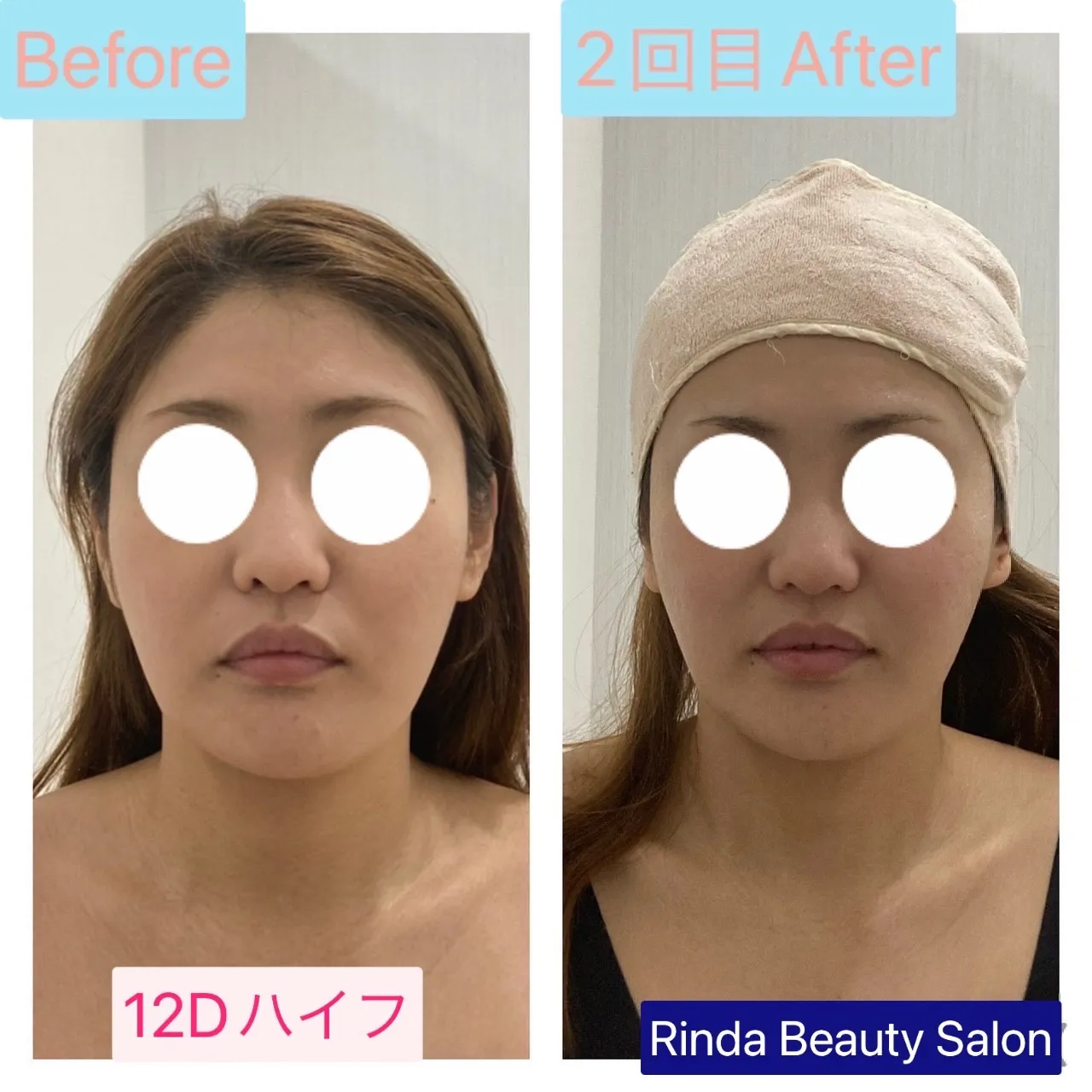 たるみ・二重アゴ撃退・小顔になるなら12Dハイフ（HIFU）|尼崎エステサロンRinda Beauty Salon