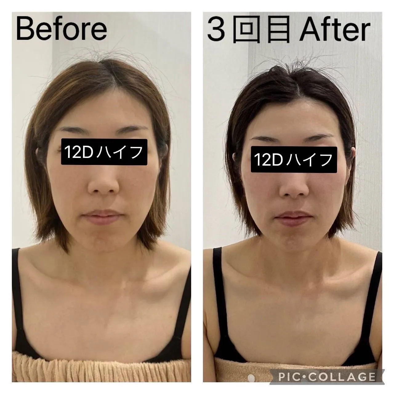 たるみ・二重アゴ撃退・小顔になるなら12Dハイフ（HIFU）|尼崎エステサロンRinda Beauty Salonリンダビューティサロン