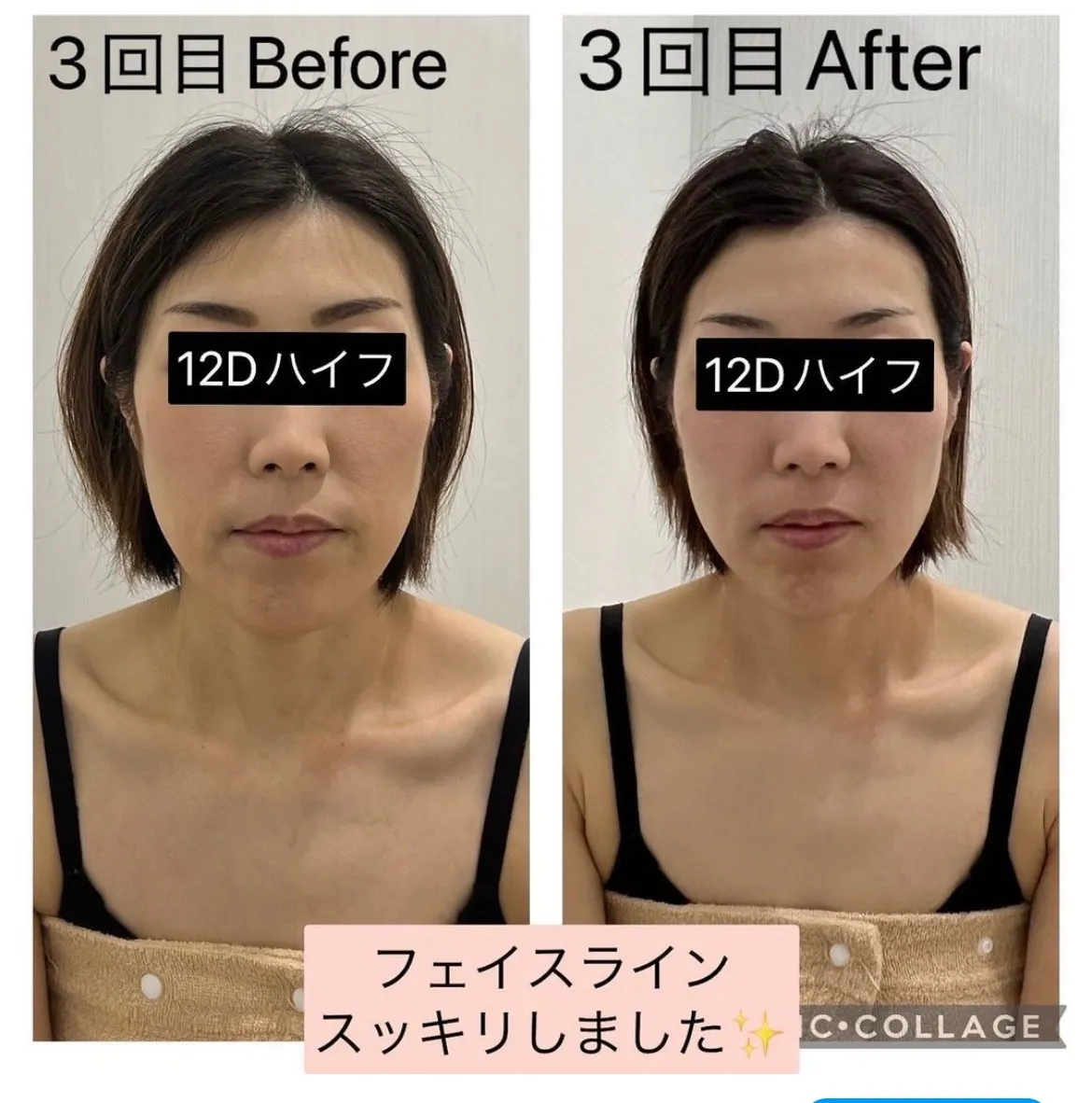 たるみ・二重アゴ撃退・小顔になるなら12Dハイフ（HIFU）|兵庫県尼崎エステサロンRinda Beauty Salonリンダビューティーサロン