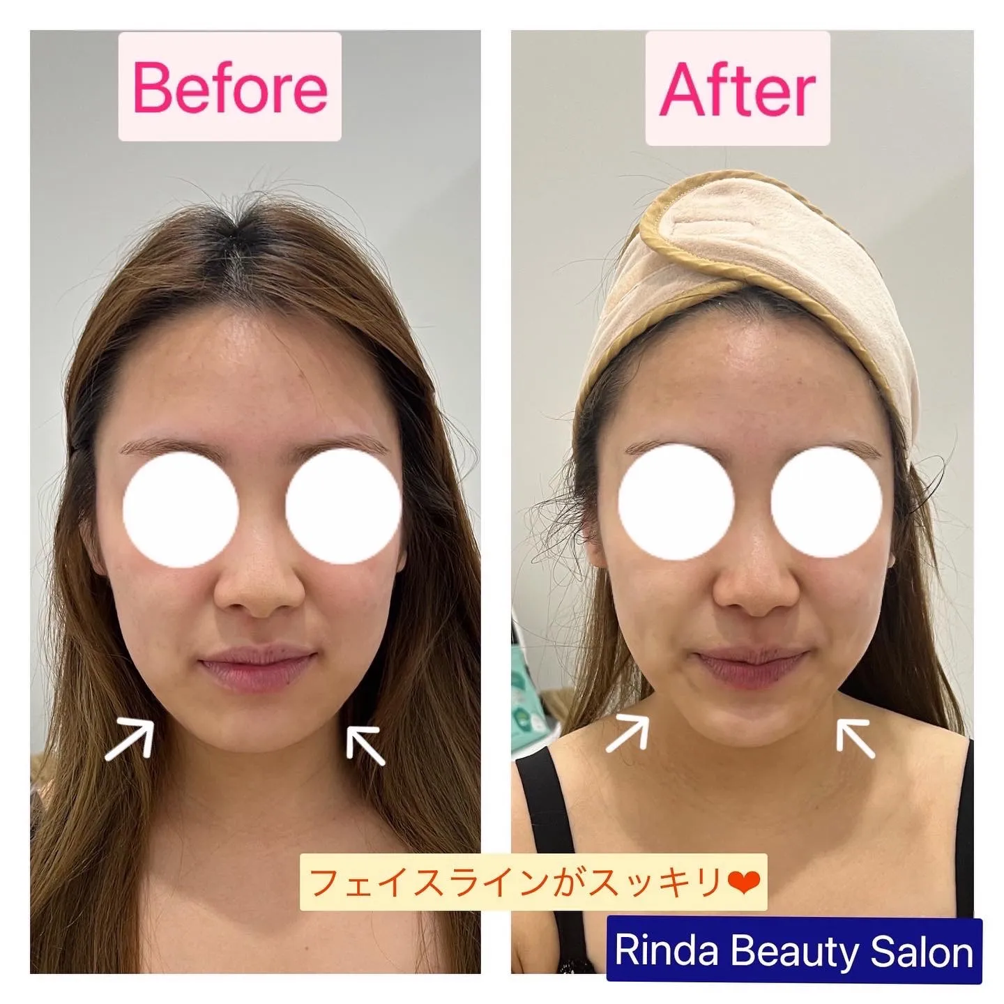 たるみや二重アゴ・ほうれい線改善で小顔になるなら12Dハイフ|尼崎エステサロンRinda Beauty Salonリンダビューティーサロン