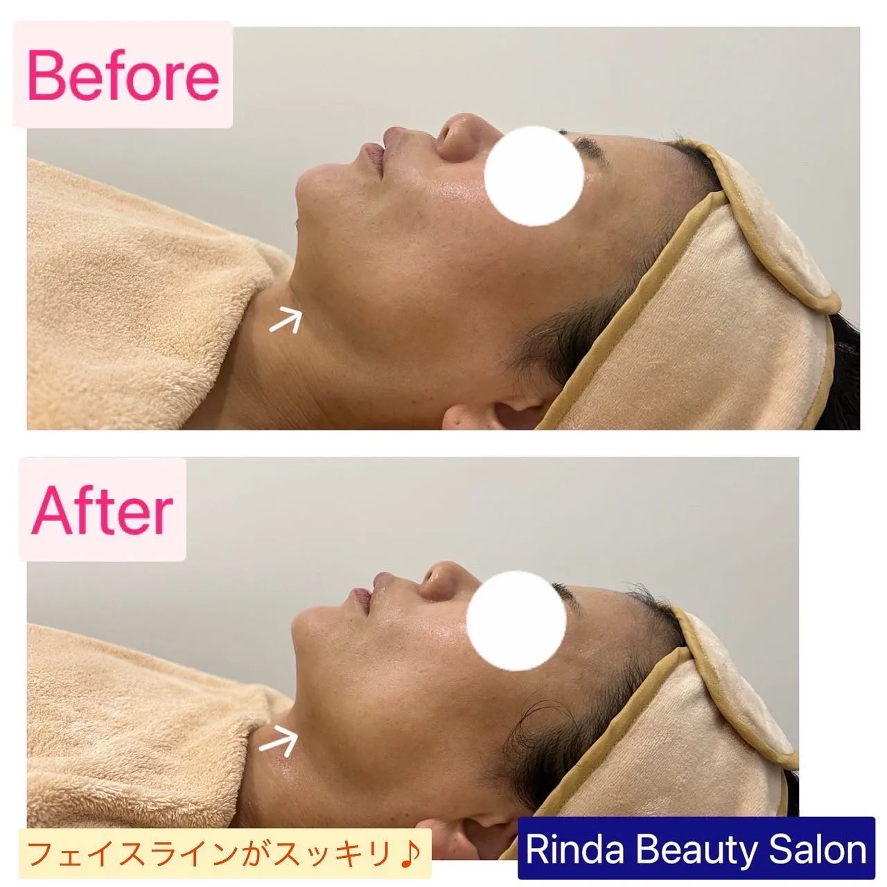 たるみ・二重アゴやほうれい線改善で小顔になるなら12Dハイフ（HIFU）|尼崎エステサロンRinda Beauty Salonリンダビューティーサロン