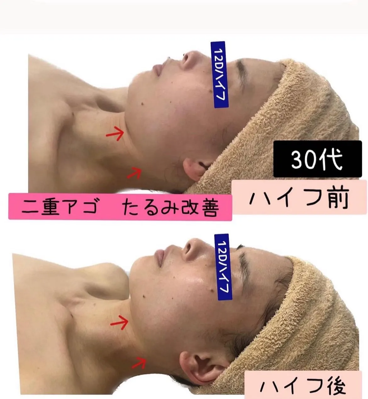 気になる二重アゴ、ほうれい線、たるみは12Dハイフで改善/兵庫（尼崎エステサロン）Rinda Beauty Salonリンダビューティーサロン