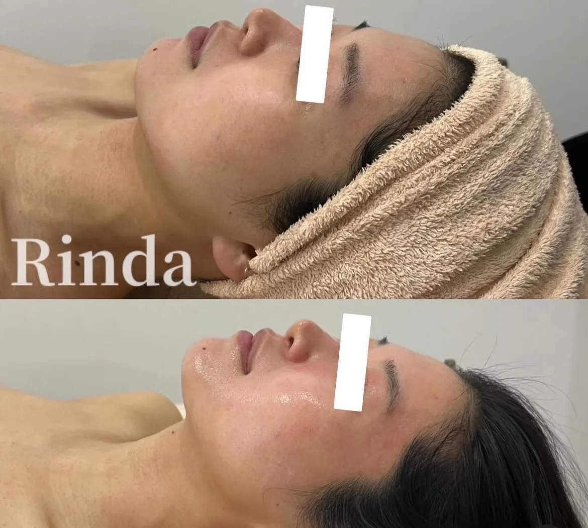 小顔　リフトアップ　引き締め　尼崎エステ