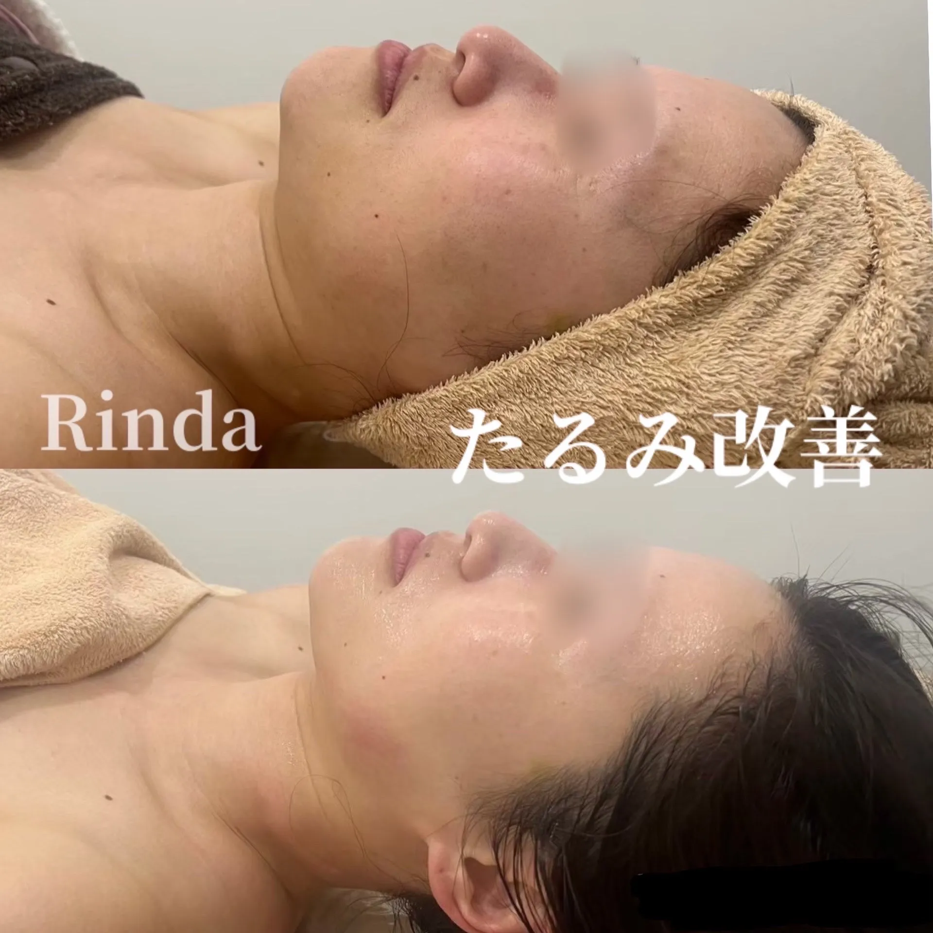 フェイスラインのもたつき、小顔やリフトアップ、ほうれい線改善には小顔メニューがオススメ！兵庫県（尼崎エステ）Rinda BeautySalonリンダビューティサロン