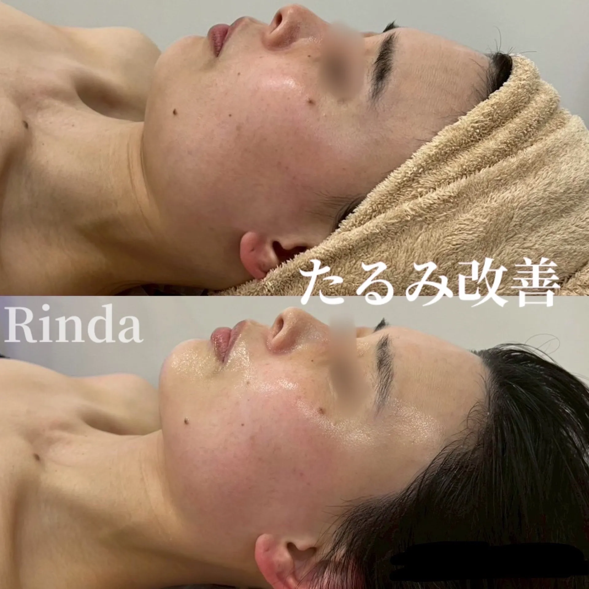 たるみが気になる、食いしばり、エラ改善、小顔、リフトアップしたい方は兵庫県（尼崎エステ）Rinda Beauty Salonリンダビューティーサロン