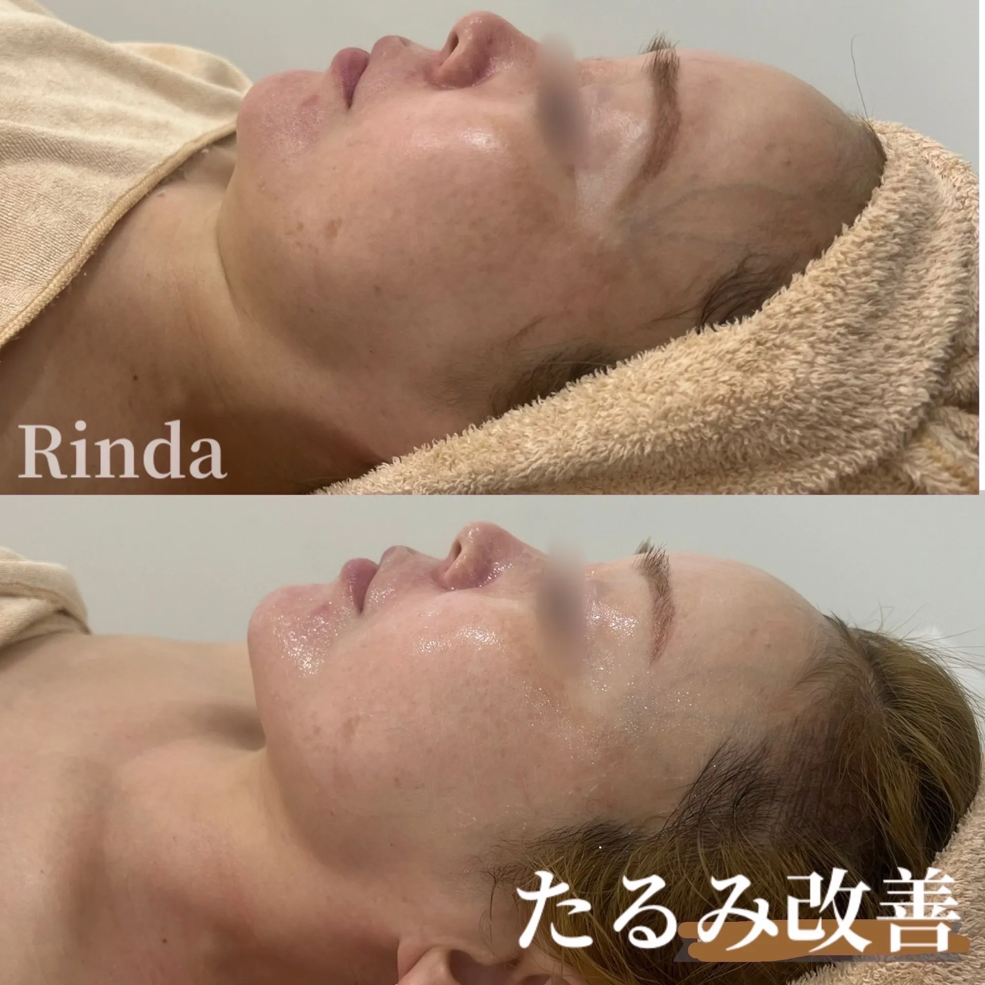 小顔.リフトアップ.二重アゴ改善.フェイスライン変えたい方はRinda@