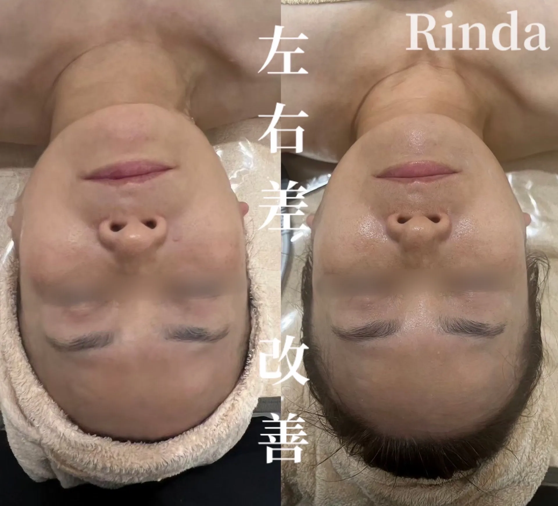 お顔のたるみ、ほうれい線、くいしばり、左右差がお悩みの方は兵庫県（尼崎エステ）Rinda Beauty Salonリンダビューティーサロンで改善しませんか？