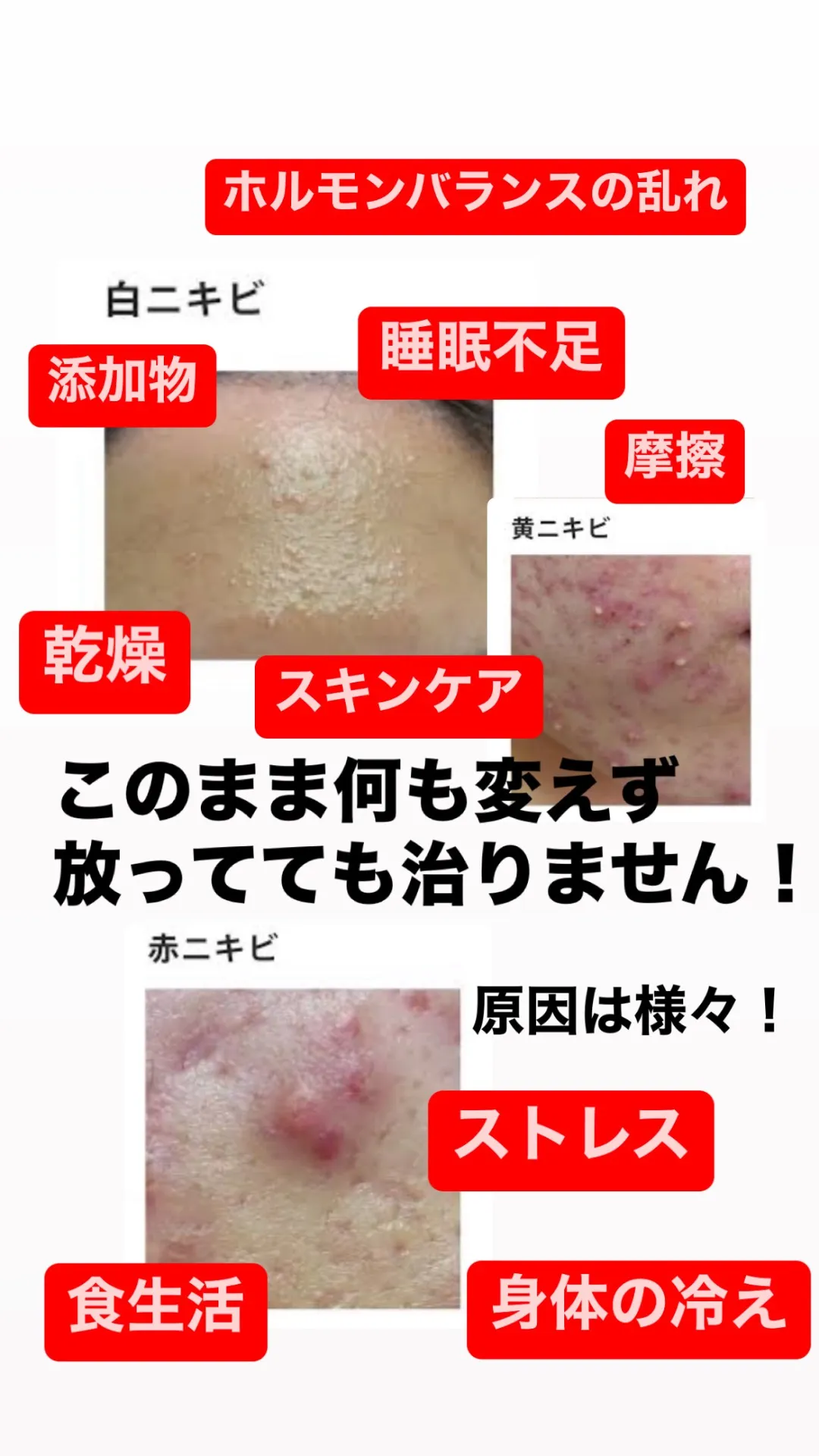 生理前に必ず繰り返すニキビや、慢性化していてしぶとく残るニキビをキレイにしたい方は兵庫県（尼崎エステ）Rinda Beauty Salonリンダビューティーサロン