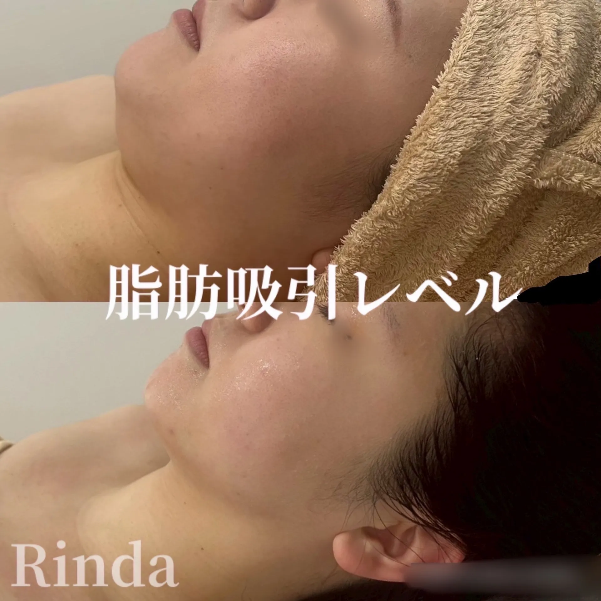 脂肪吸引不要！リフトアップ小顔で、フェイスラインのもたつきをなくし、くっきりした輪郭へ！兵庫県（尼崎エステ）RindaBeauty Salonリンダビューティーサロン
