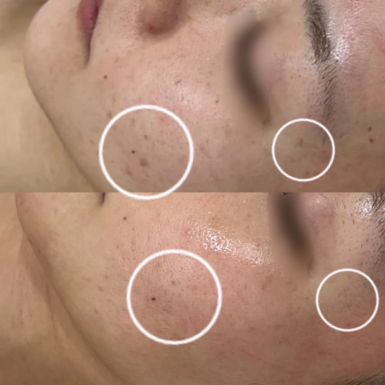 思春期の頃のニキビ跡、お顔の赤みを改善したい方はハーブピーリングが効果的！兵庫県（尼崎エステ）Rinda Beauty Salonリンダビューティーサロン