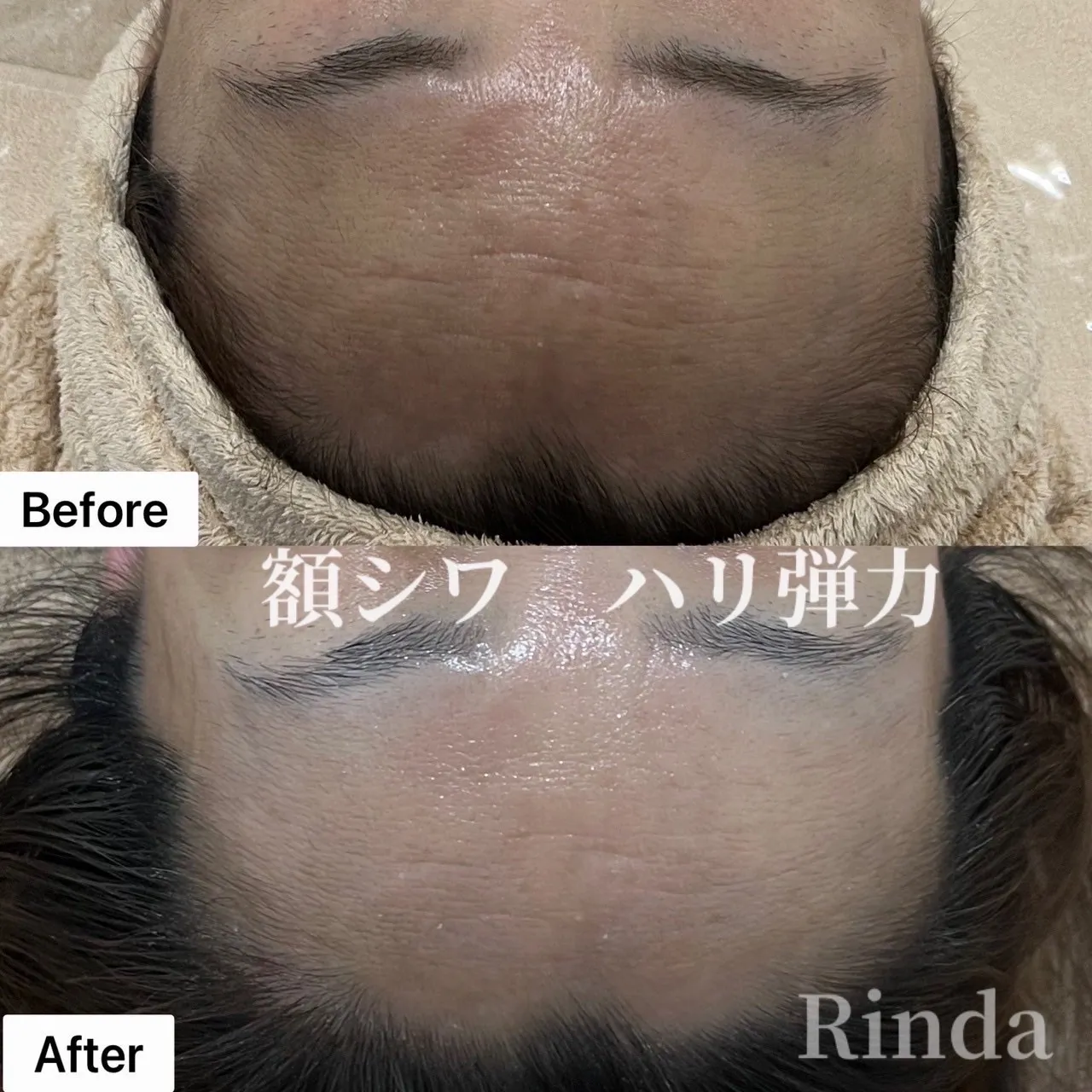 尼崎で額シワ・ハリに悩んだら大人肌の救世主、尼崎で話題のクリスティーナフェイシャルで改善！兵庫県（尼崎エステ）Rinda Beauty Salonリンダビューティーサロン