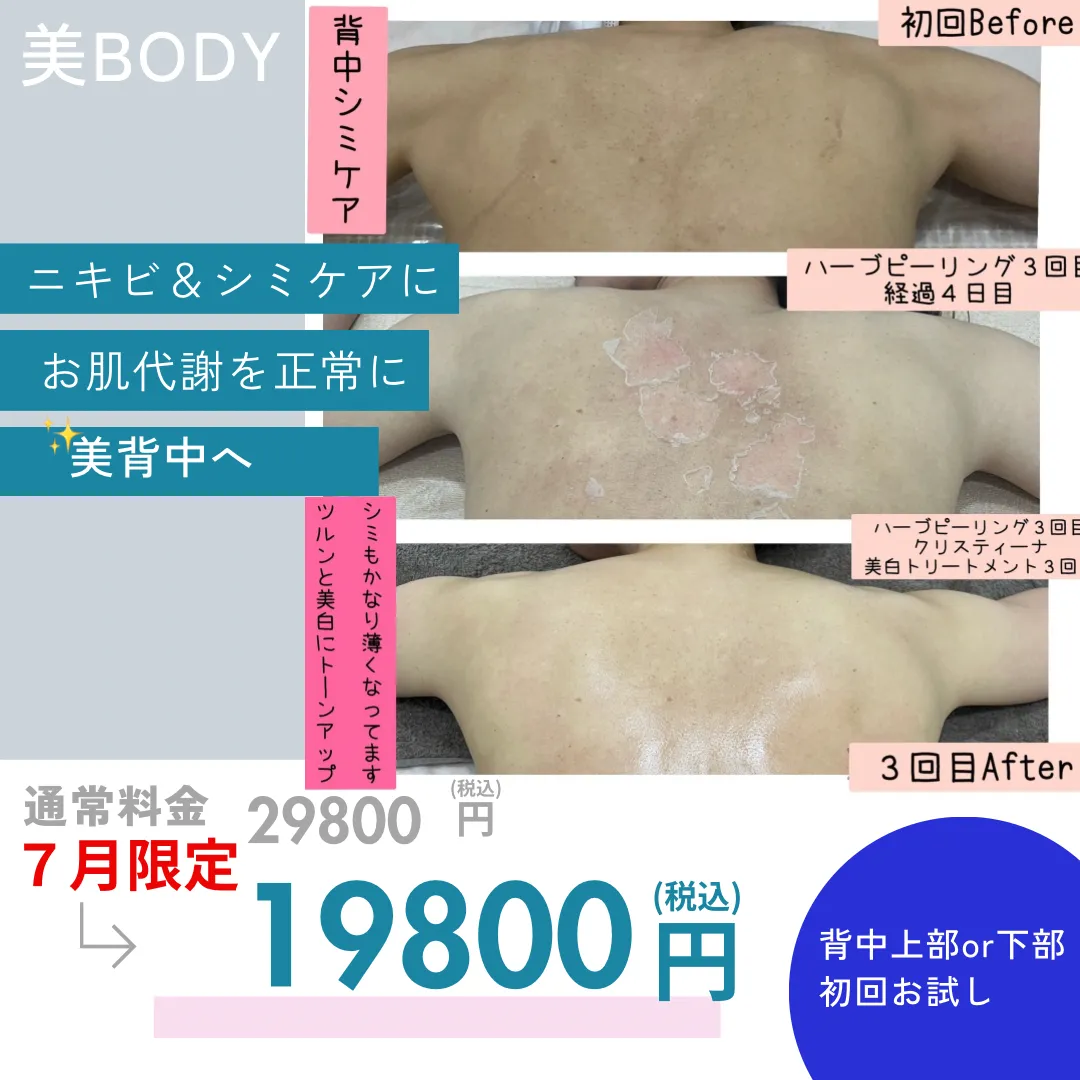 ブライダルや水着前にも！ニキビ跡、繰り返しニキビ、炎症ニキビ背中のシミ、色素沈着、くすみ、赤み…背中トラブルを根本ケア【尼崎の肌質改善専門エステ】兵庫県（尼崎エステ）Rinda Beauty Salonリンダビューティーサロン