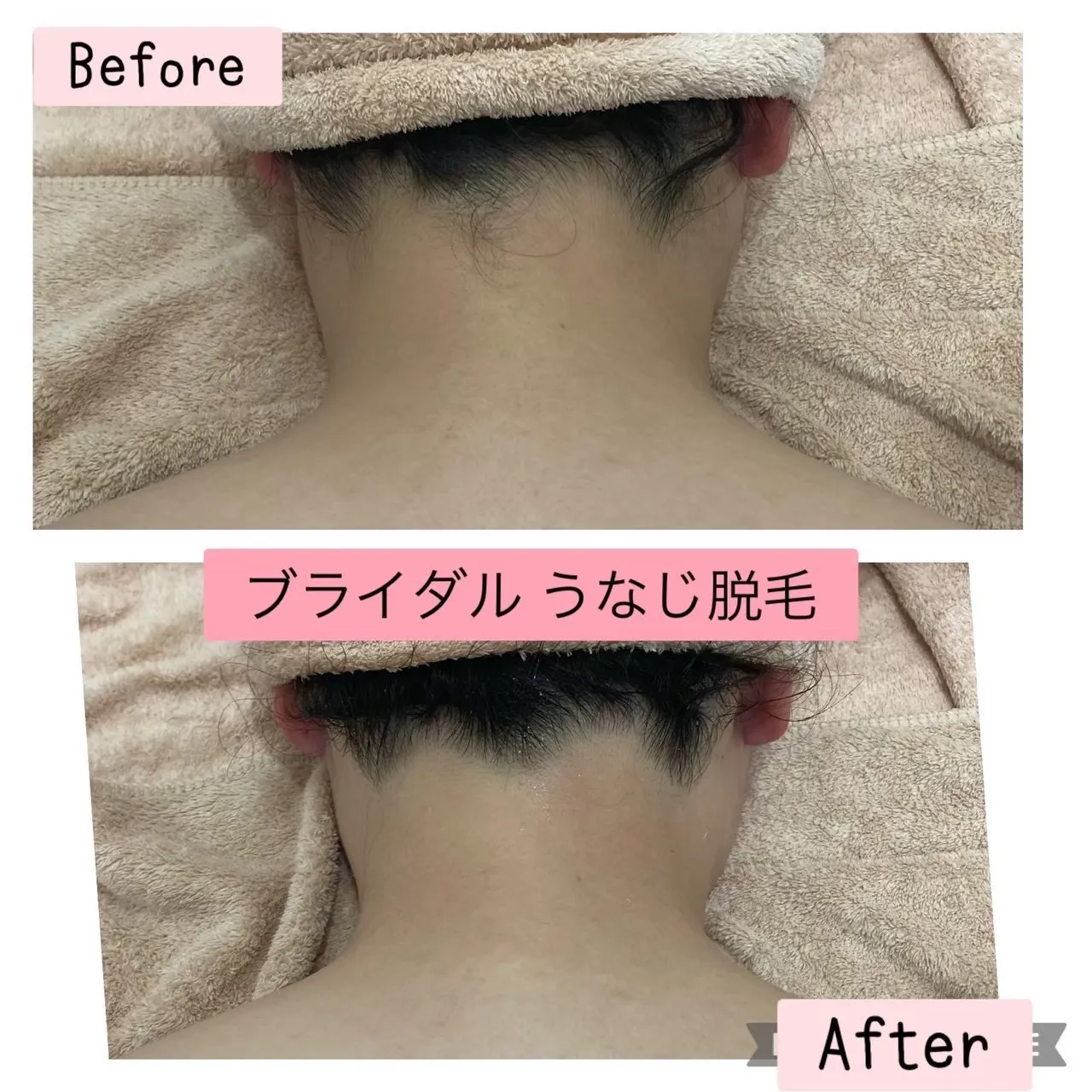 尼崎で脱毛をお探しながら必見！！7月お得なサマーキャンペーンで最安直！兵庫県（尼崎エステ）Rinda Beauty Salonリンダビューティサロン