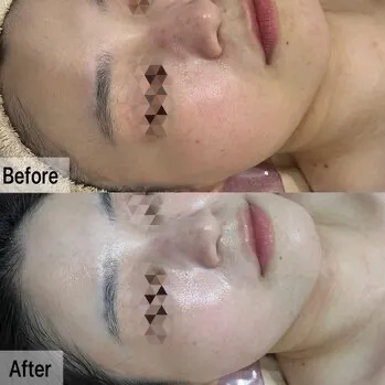 顔脱毛×鼻毛穴洗浄×アンストレス　トリプル毛穴レス