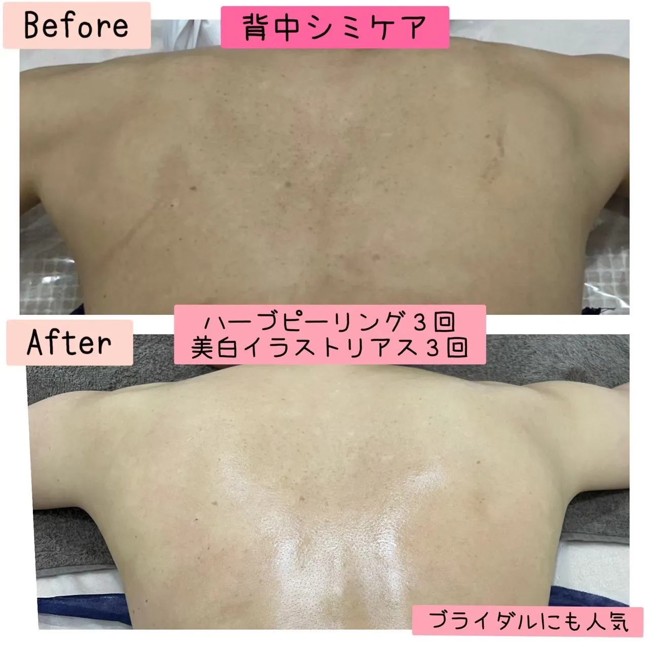 	•	「何年も消えなかった身体のシミ改善」長年のお悩みの方、ブライダルエステにもおすすめ！兵庫県（尼崎エステ）Rinda Beauty Salonリンダビューティーサロン