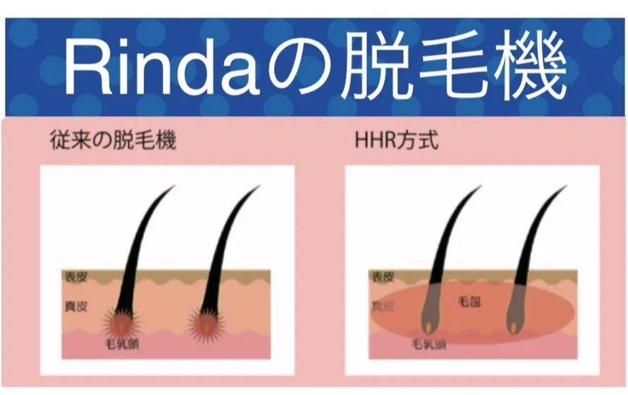 ブライダル脱毛したい方、キッズ脱毛6500円〜をしたい方も最新のHHR式のハイブリッド脱毛で最短改善しませんか？兵庫県（尼崎エステ）Rinda Beauty Salonリンダビューティーサロン