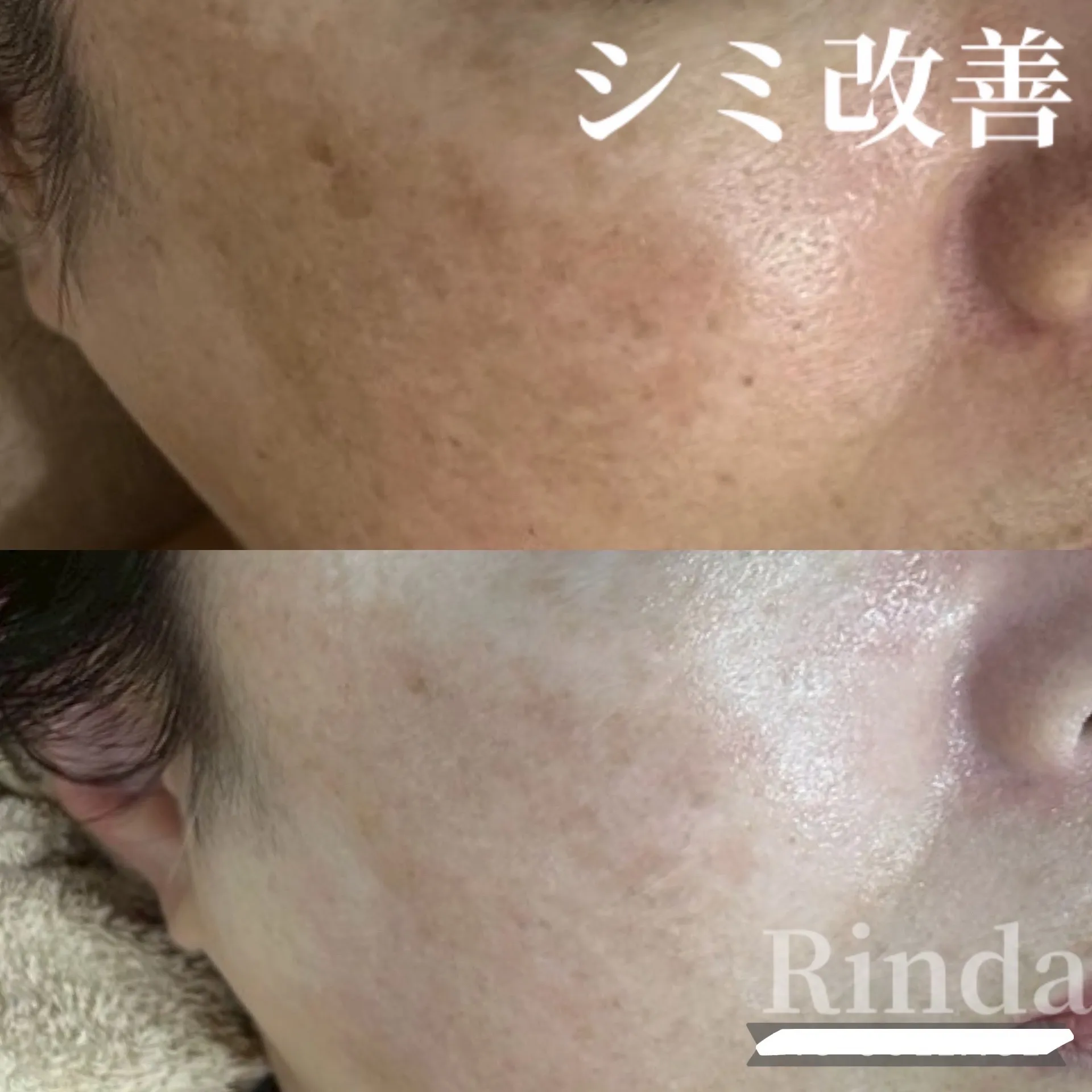 レーザーでも取れなかったシミを無くしたい方、諦めていませんか？リンダなら中に潜んでいるシミ改善までできます！兵庫県（尼崎エステ）Rinda Beauty Salonリンダビューティーサロン