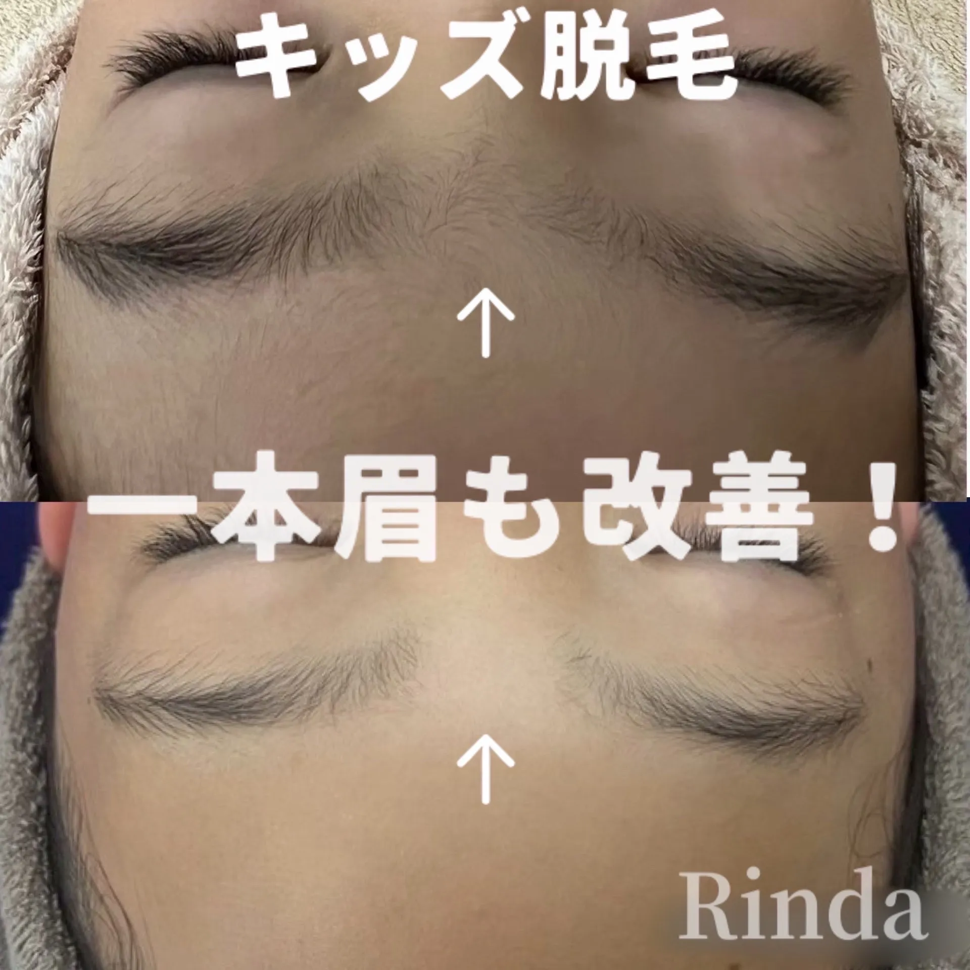 キッズ脱毛で安心して任せられる国産脱毛マシンで安心！兵庫県（尼崎エステ）Rinda Beauty Salonリンダビューティーサロン