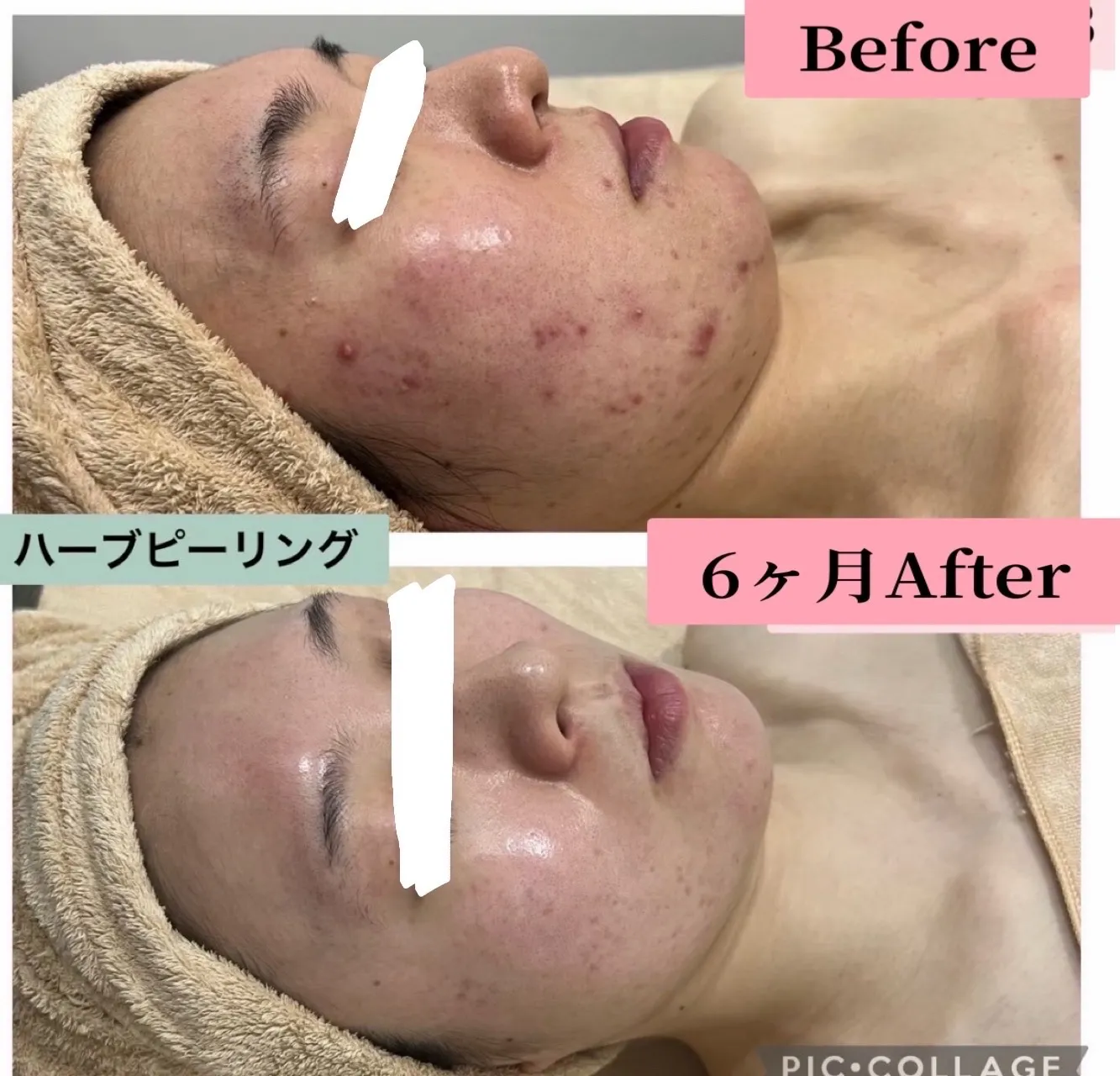 30代以降の方、次世代ハーブピーリングで口周りやフェイスラインの大人ニキビの原因を根本改善しませんか？兵庫県（尼崎エステ）Rinda Beauty Salonリンダビューティーサロン