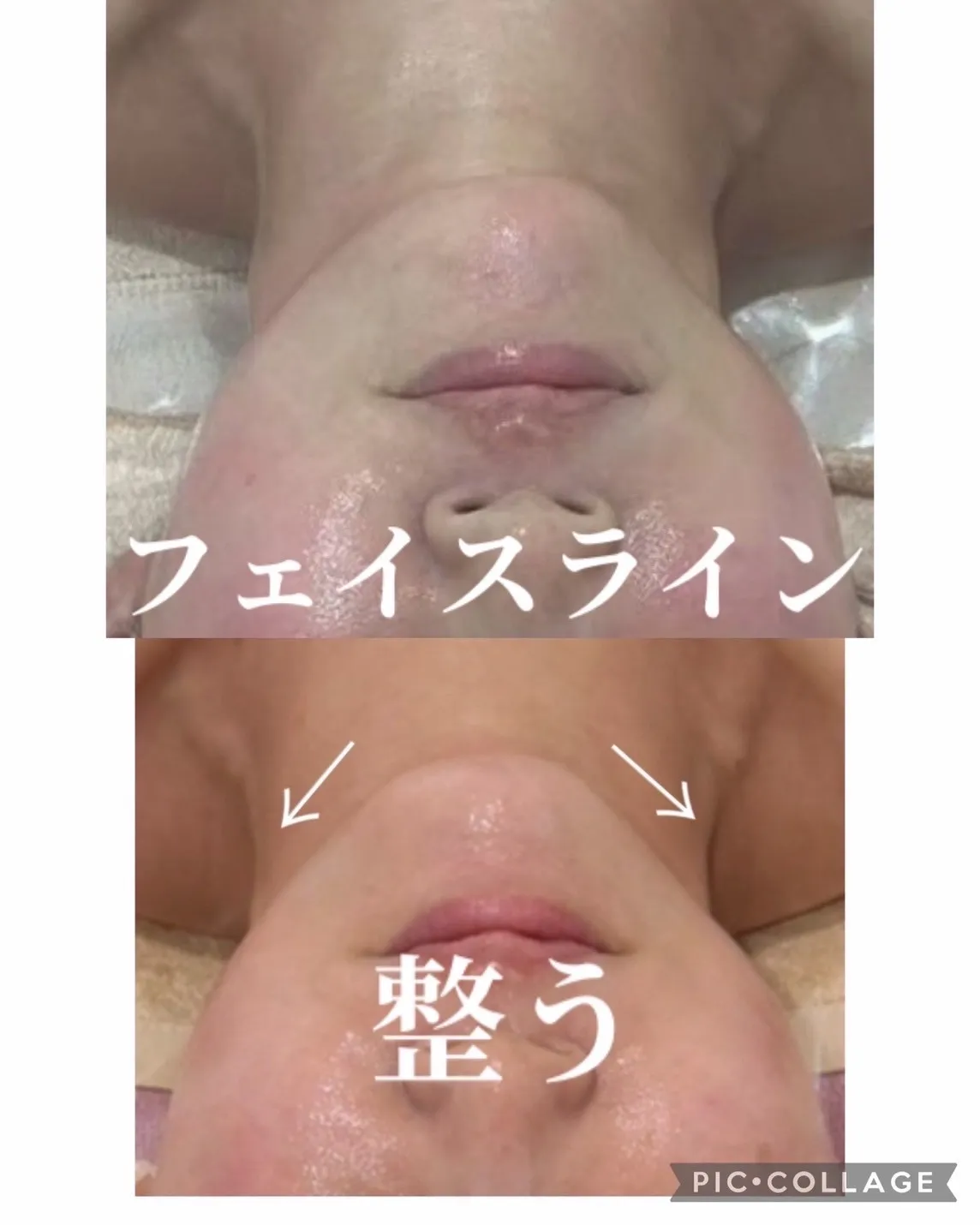 JR尼崎でここだけ！フォースカッターフェイシャル！ダウンタイムなし！兵庫県（O）参ってるほどら