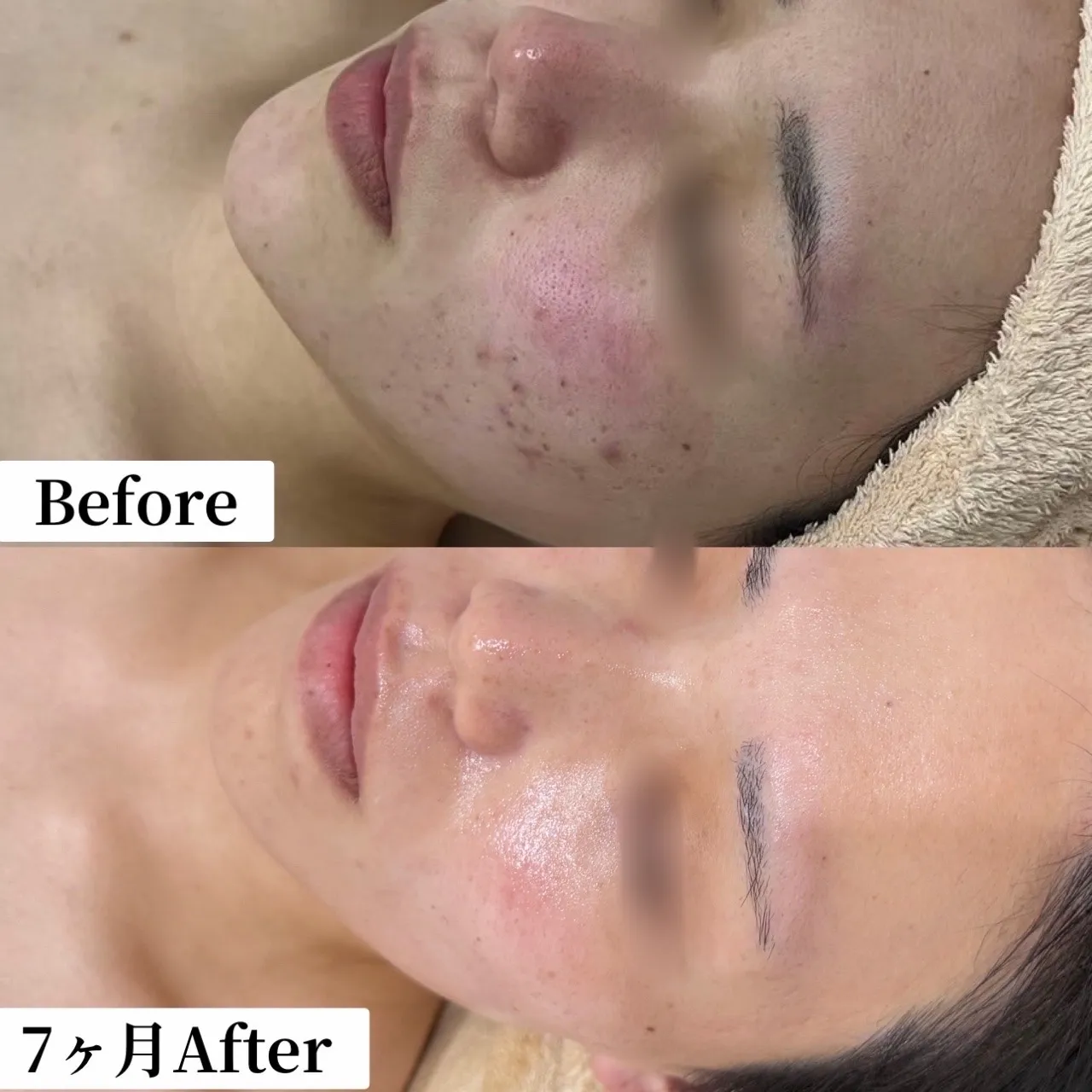 ポツッとニキビ、ニキビ跡でお悩みの方、妊婦さん妊娠中のゆらぎ肌改善へ！兵庫県（尼崎エステ）Rinda Beauty Salonリンダビューティーサロンへ