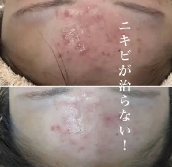 繰り返す治らないニキビに悩んでいませんか？理由は一つではありません。根本改善なら（尼崎フェイシャルエステ）Rinda Beauty Salonリンダビューティーサロンへ