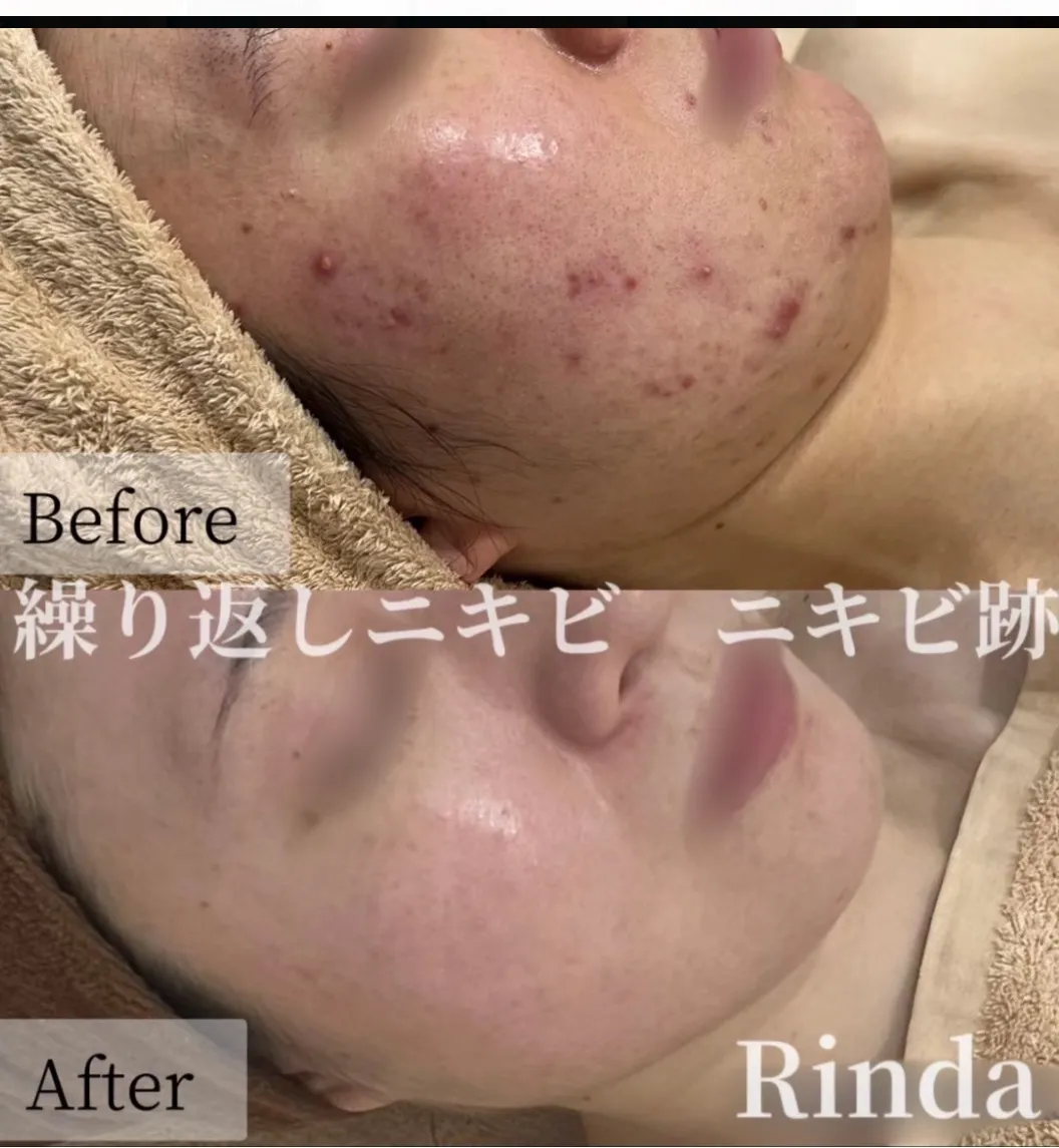 【尼崎フェイシャルエステRindaリンダ】つらい繰り返しニキビは、実は乾燥が原因かも？！