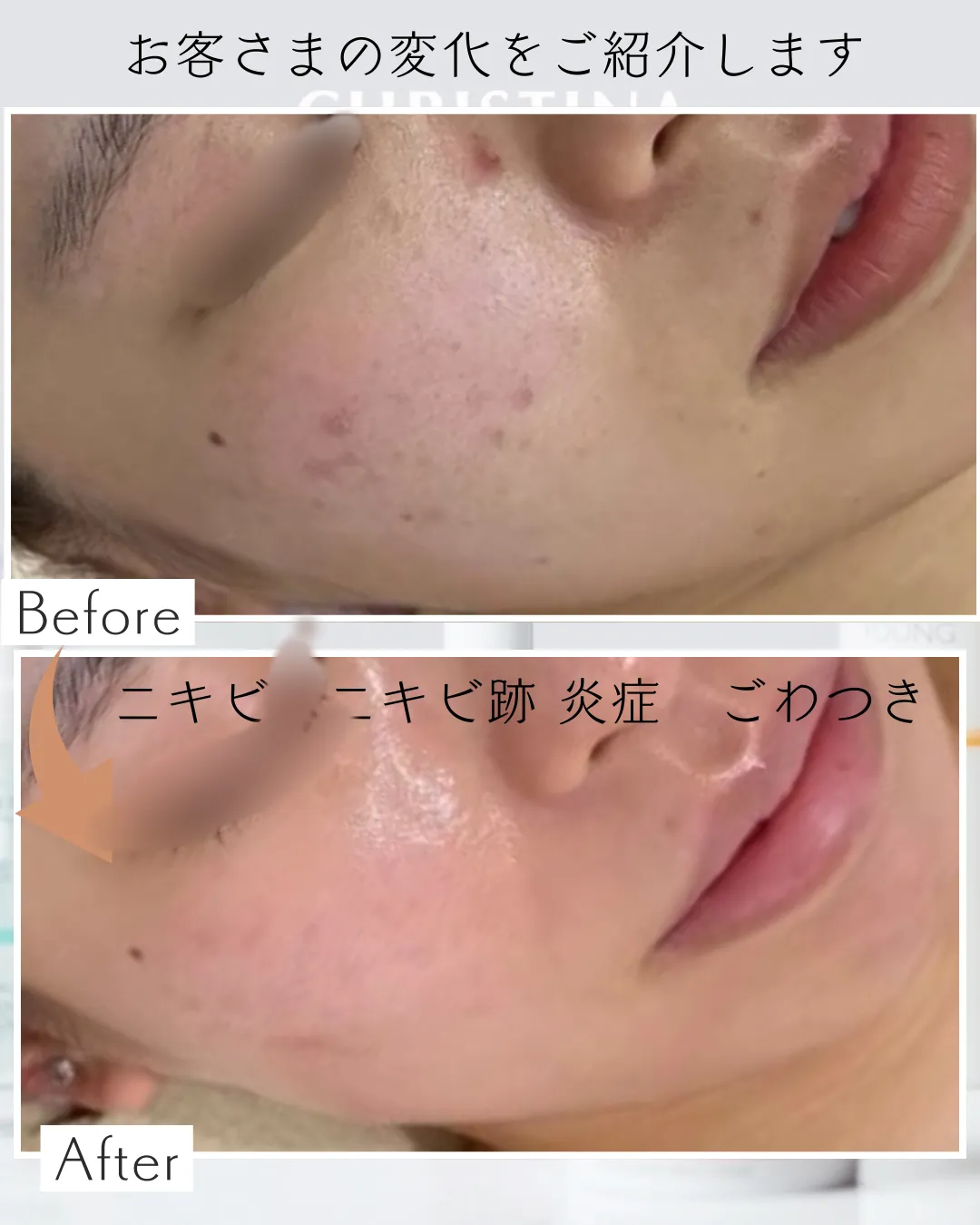 ニキビ跡・繰り返しニキビに悩む方へ（尼崎駅前/肌質改善フェイシャルエステ）