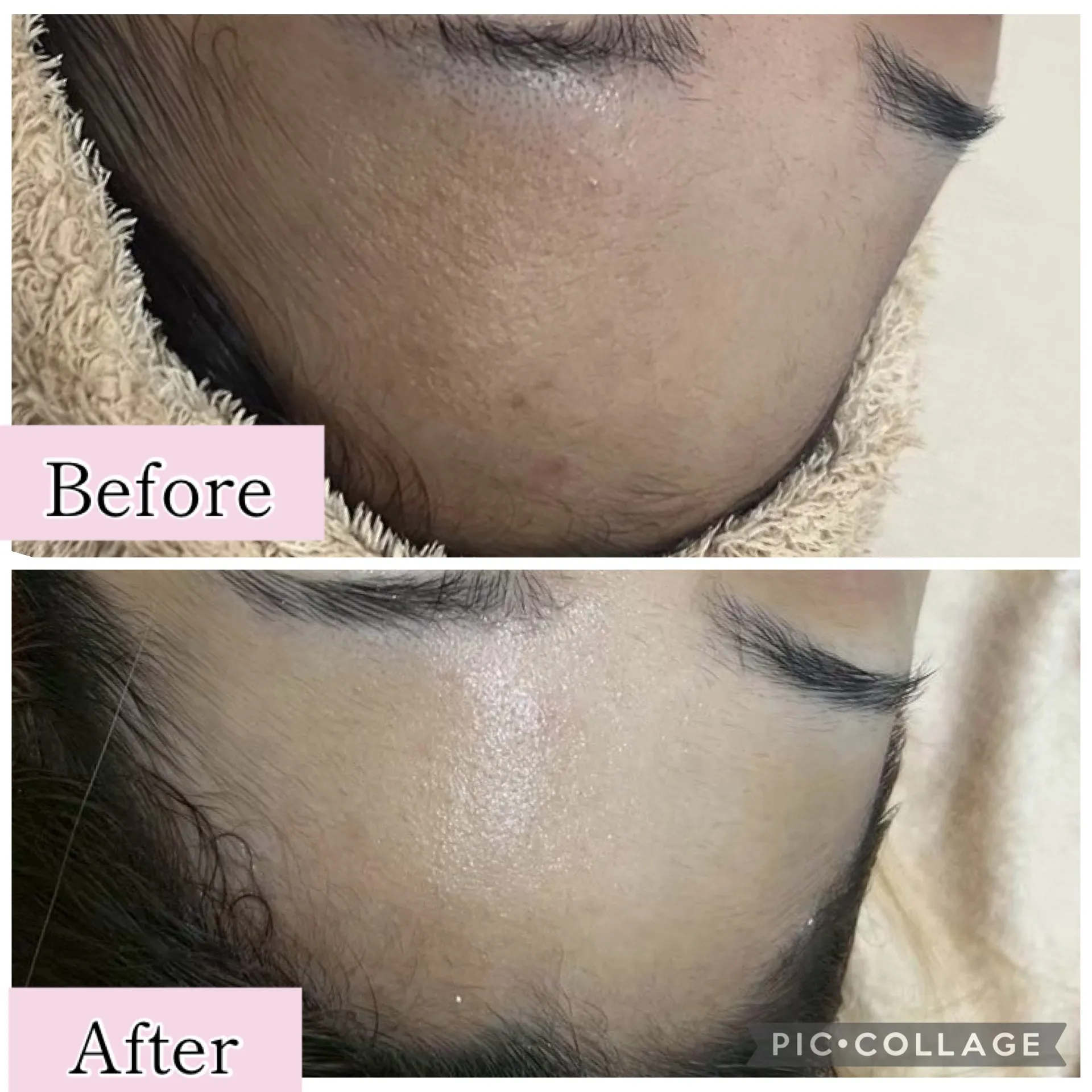 【尼崎肌質改善フェイシャルエステ】肌のごわつき・くすみ・角栓詰まりが気になる方へ｜透明感あるツヤ肌へ