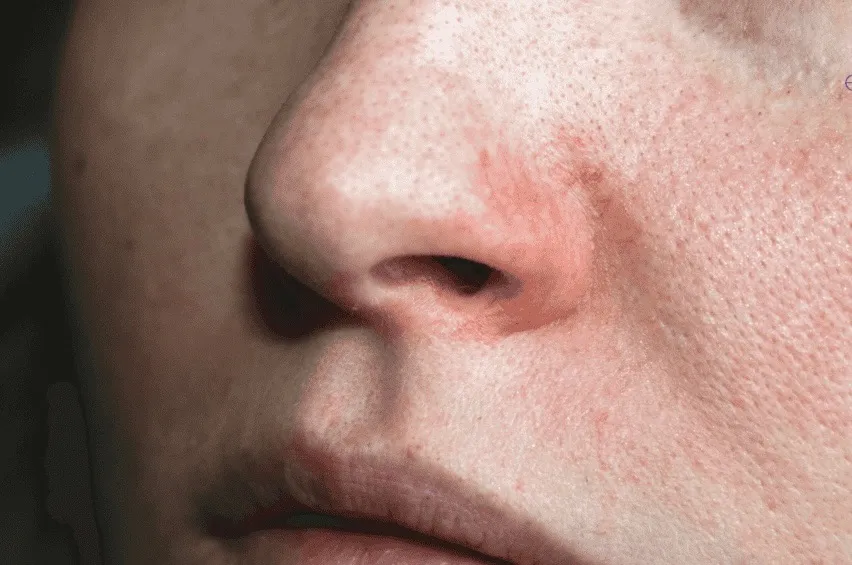 【尼崎エステ】花粉で肌荒れ・かゆみが出る原因と改善方法｜肌質改善フェイシャル