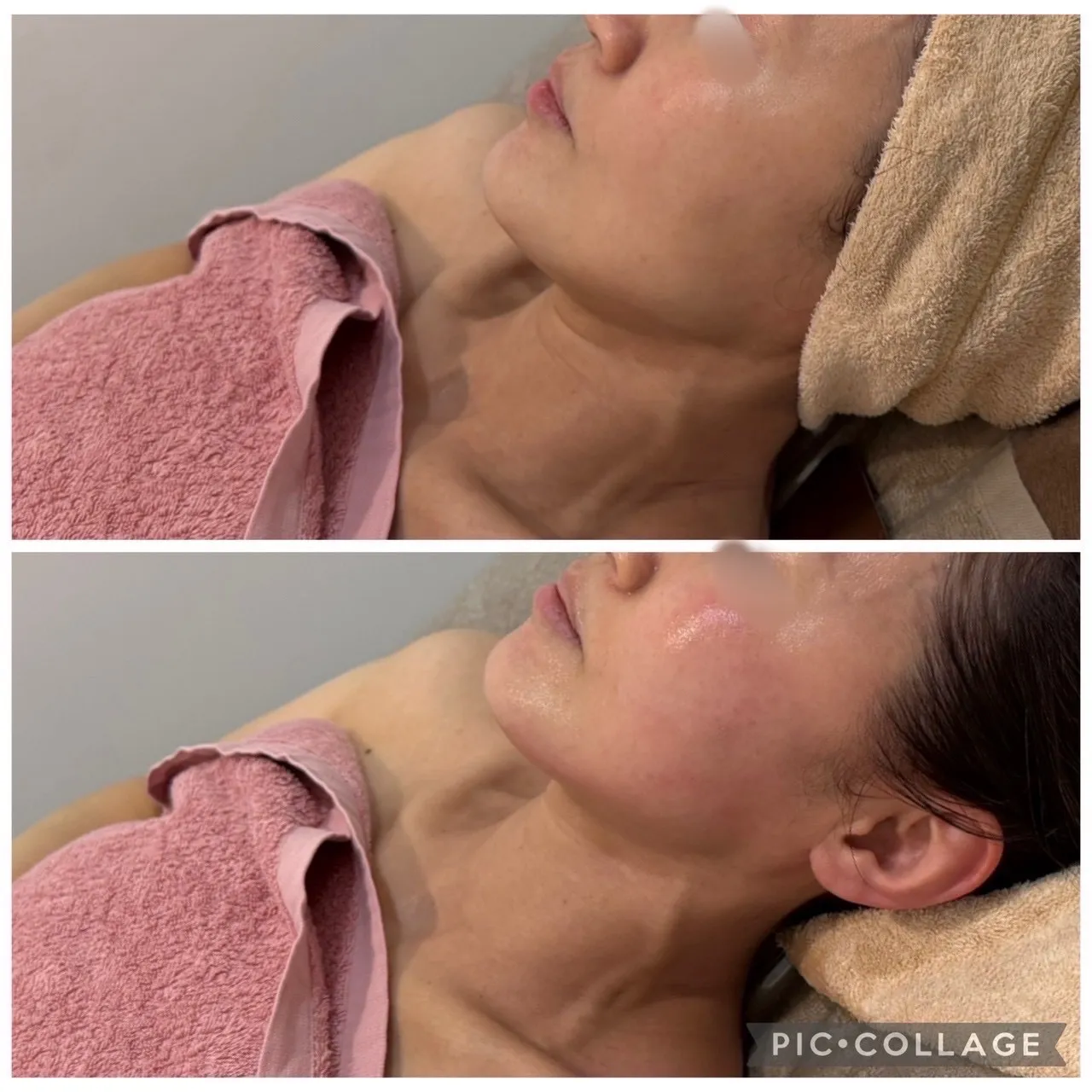 【尼崎エステ】30代からのたるみ・エラ張り・左右差の原因と改善方法