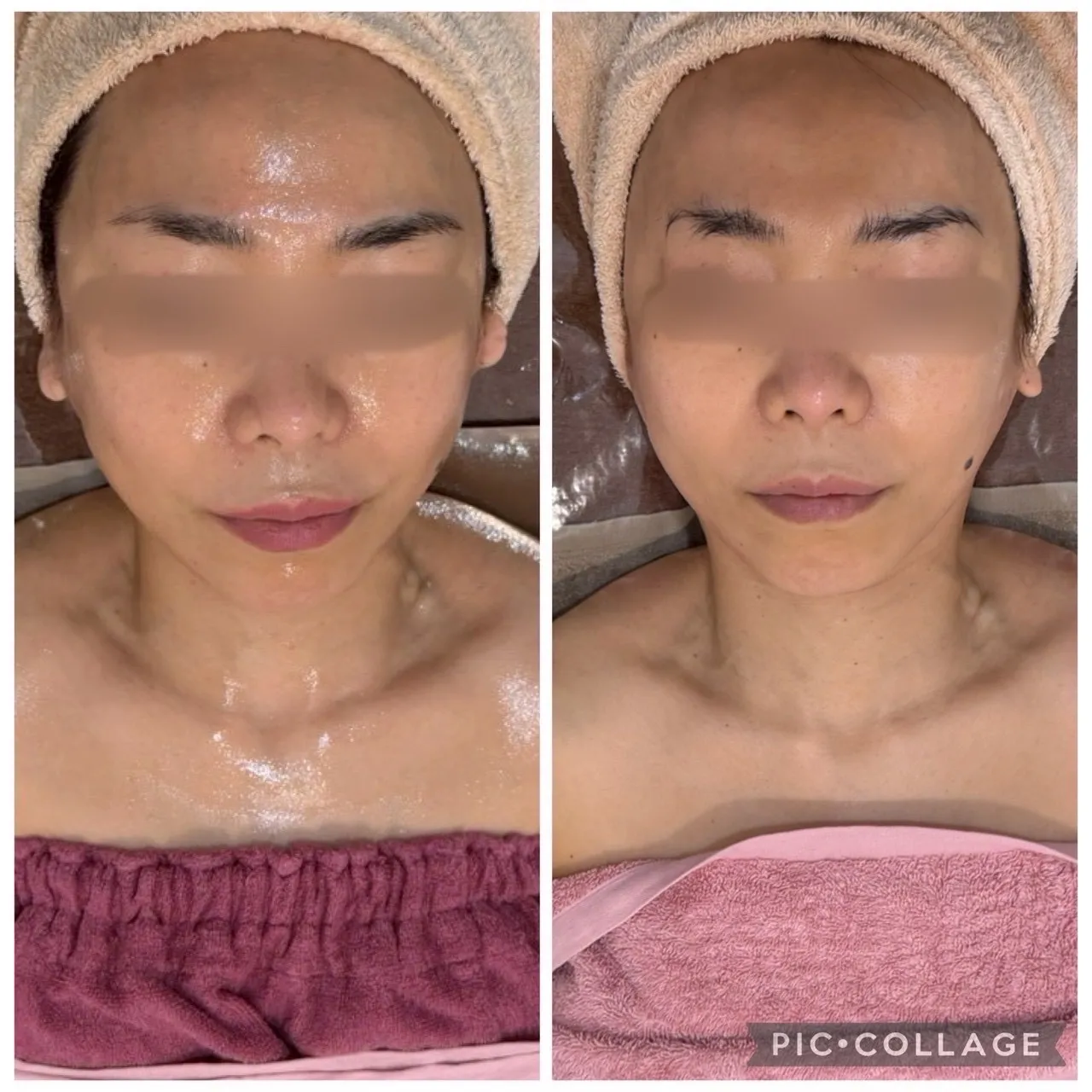 尼崎で左右差・たるみ改善ならRindaリンダで小顔に｜リフトアップ×小顔×むくみ解消で若見え肌へ