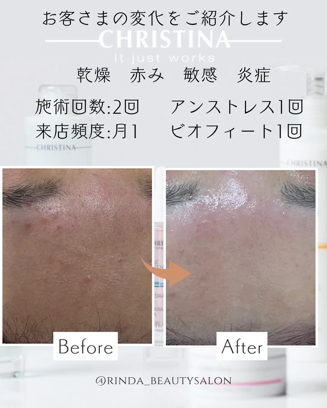 【尼崎で繰り返すニキビ・ニキビ跡赤みの改善しませんか?兵庫県(尼崎エステ)RindaBeautySalonリンダビューティーサロン