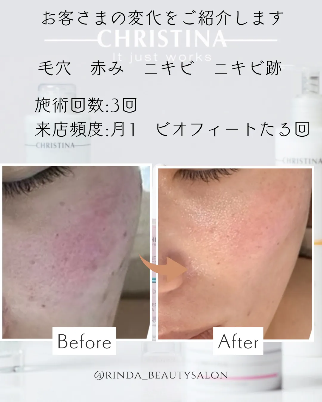 【尼崎駅前エステサロン/肌質改善】4月のゆらぎ肌に…花粉・乾燥・赤みを徹底ケア!