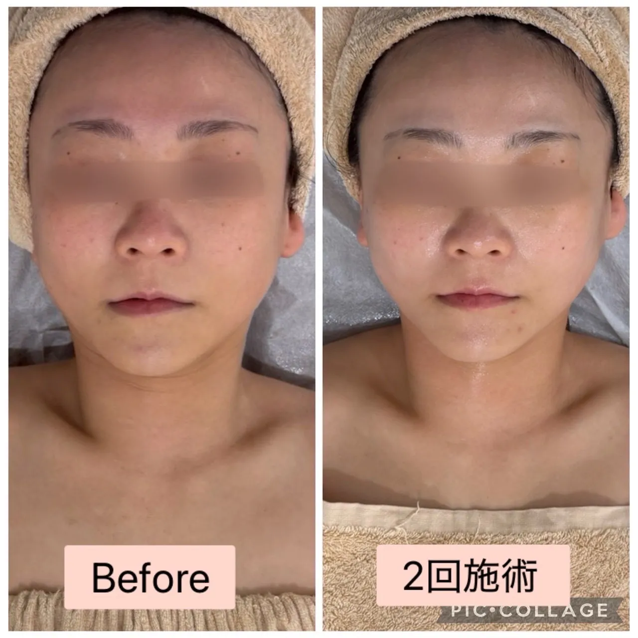 【尼崎/小顔】30代からのたるみ・左右差に。食いしばり肩こりもスッキリ!溶ける針で肌質改善