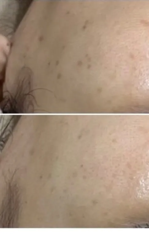 【尼崎肌質改善エステ】シミ改善|ハーブピーリング1回でここまで変わる理由とは?