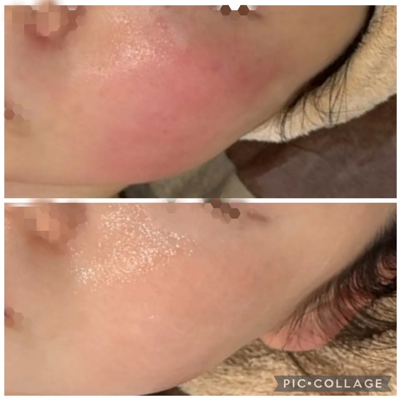 赤ら顔、赤み炎症、マスクあれ、敏感乾燥肌を尼崎駅前エステRindaでお悩み解決しませんか。