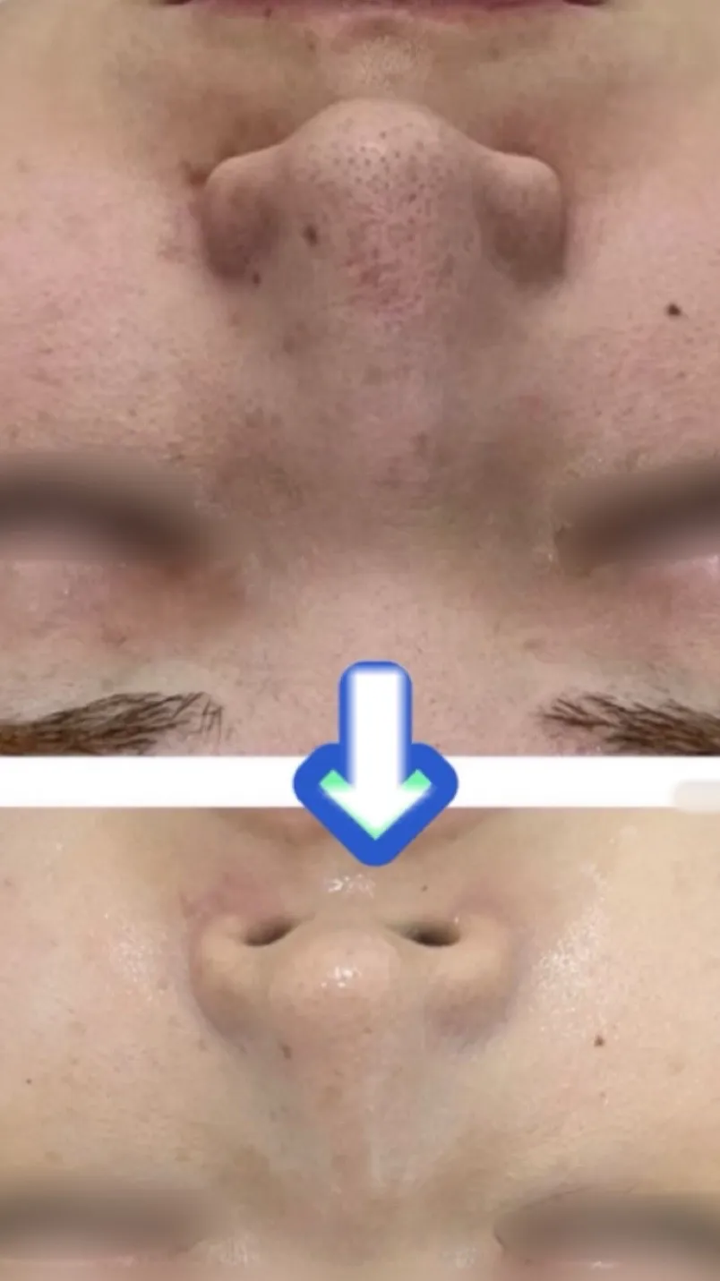 JR尼崎駅前徒歩2分で毛穴、黒ずみを改善したい方はRindaリンダへ