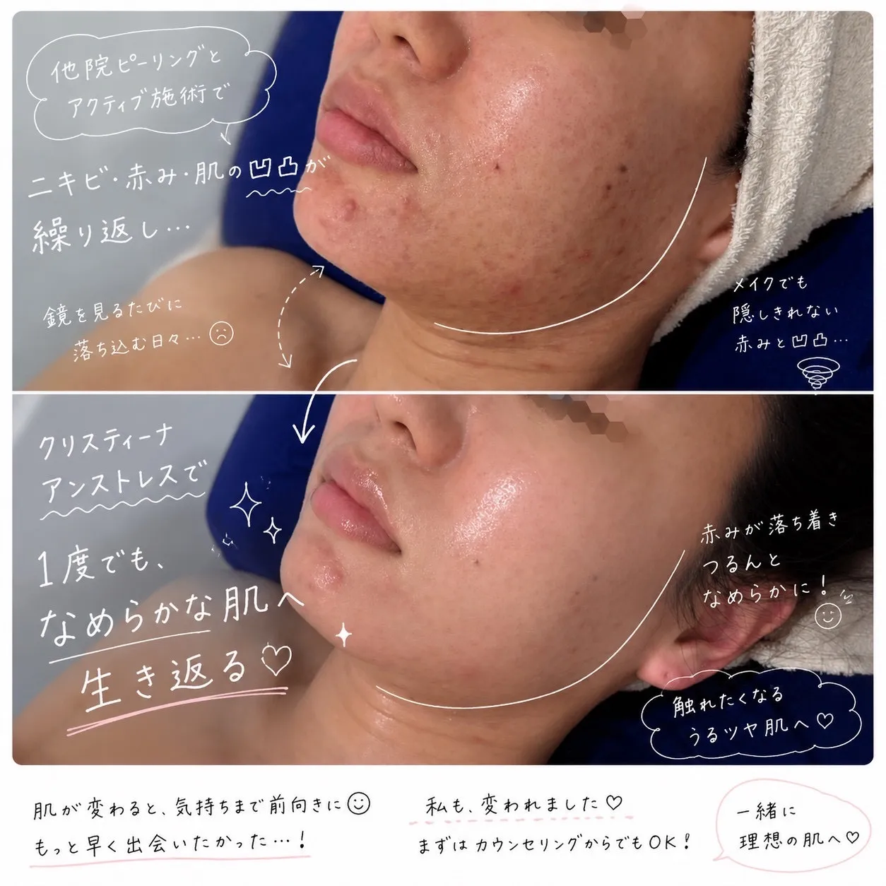 JR尼崎駅前肌質改善フェイシャルエステサロン「繰り返すニキビ・赤みに終止符。プロが教える『肌質改善』の最短ルート」