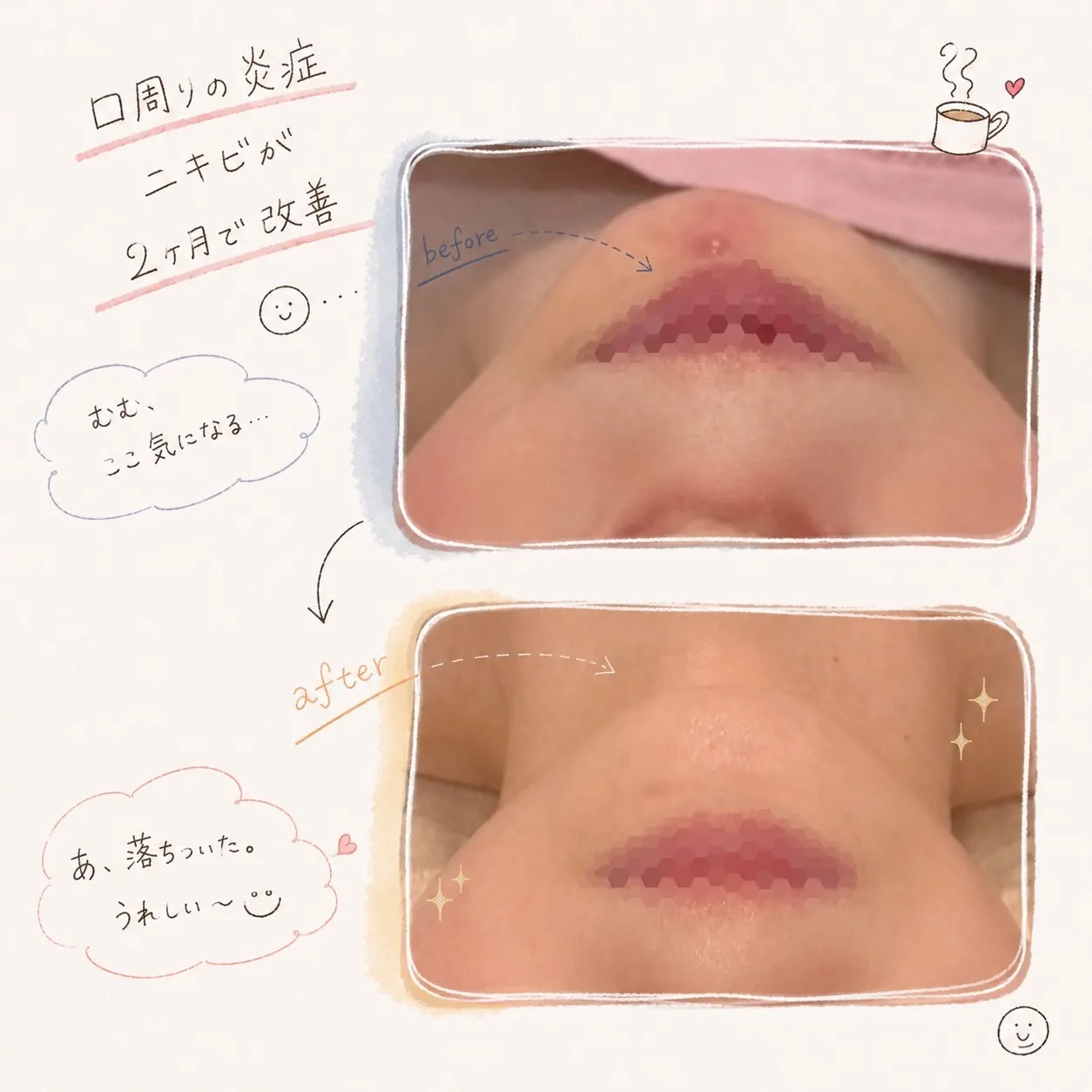 【JR尼崎肌質改善エステ】お顔の赤み、繰り返す口周りニキビに悩んでいたお客様の変化