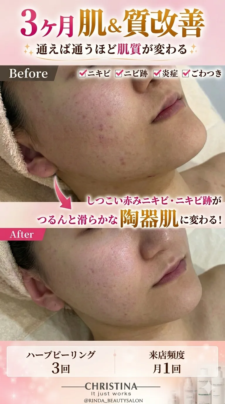 【尼崎・フェイスラインニキビ】 3ヶ月・月1回で陶器肌へ。 繰り返す赤みニキビ・ニキビ跡を根本から肌質改善