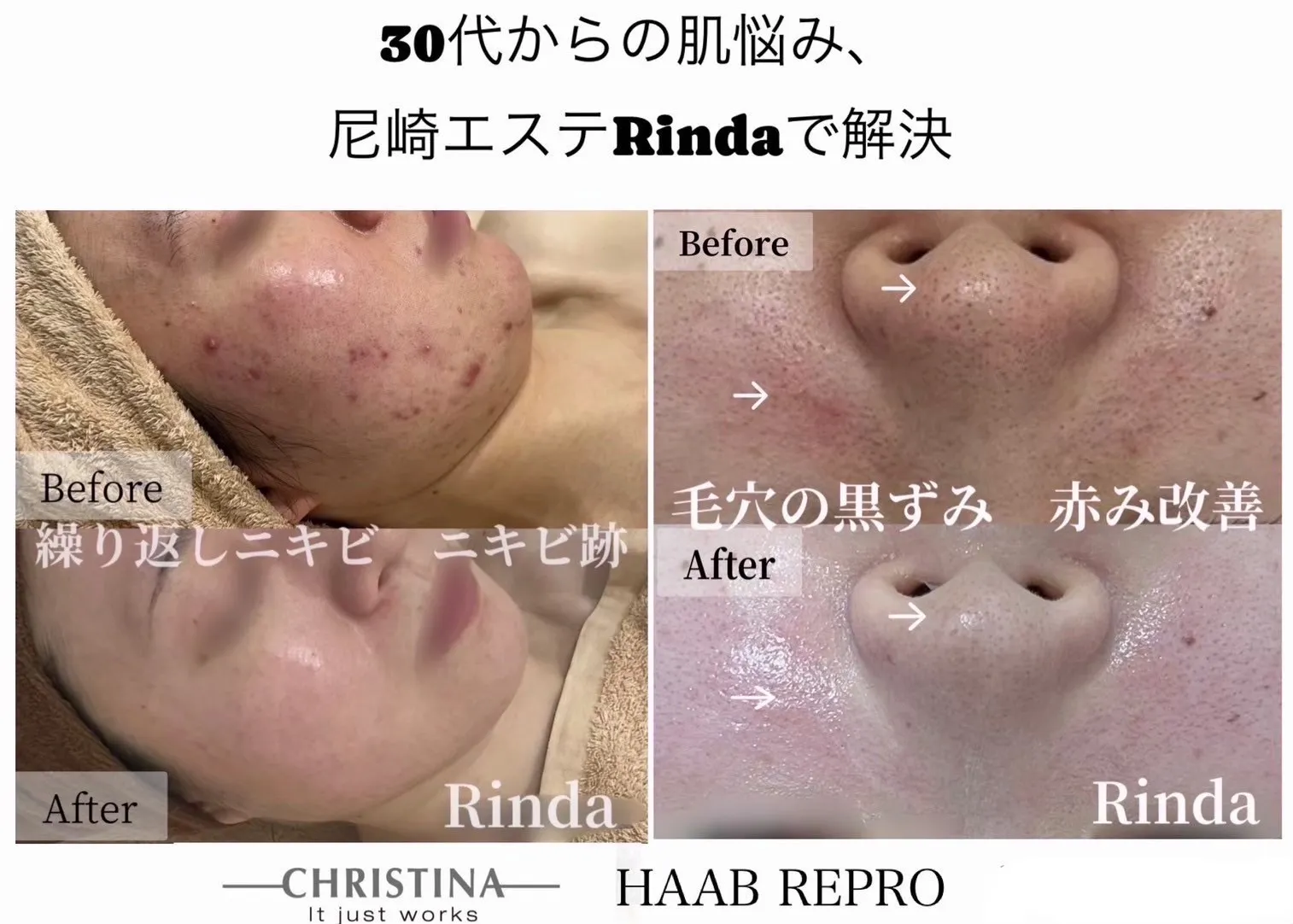 【JR尼崎駅前フェイシャルサロンRindaでニキビケア】「繰り返す」のはなぜ?お肌の状態を理解し、改善へ
