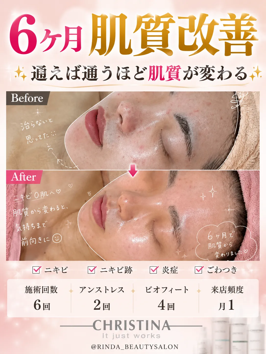 【JR尼崎駅前/肌質改善フェイシャルエステで肌質改善】6ヶ月でここまで変わる。ニキビ・ニキビ跡に悩んでいたお客様の変化をご紹介