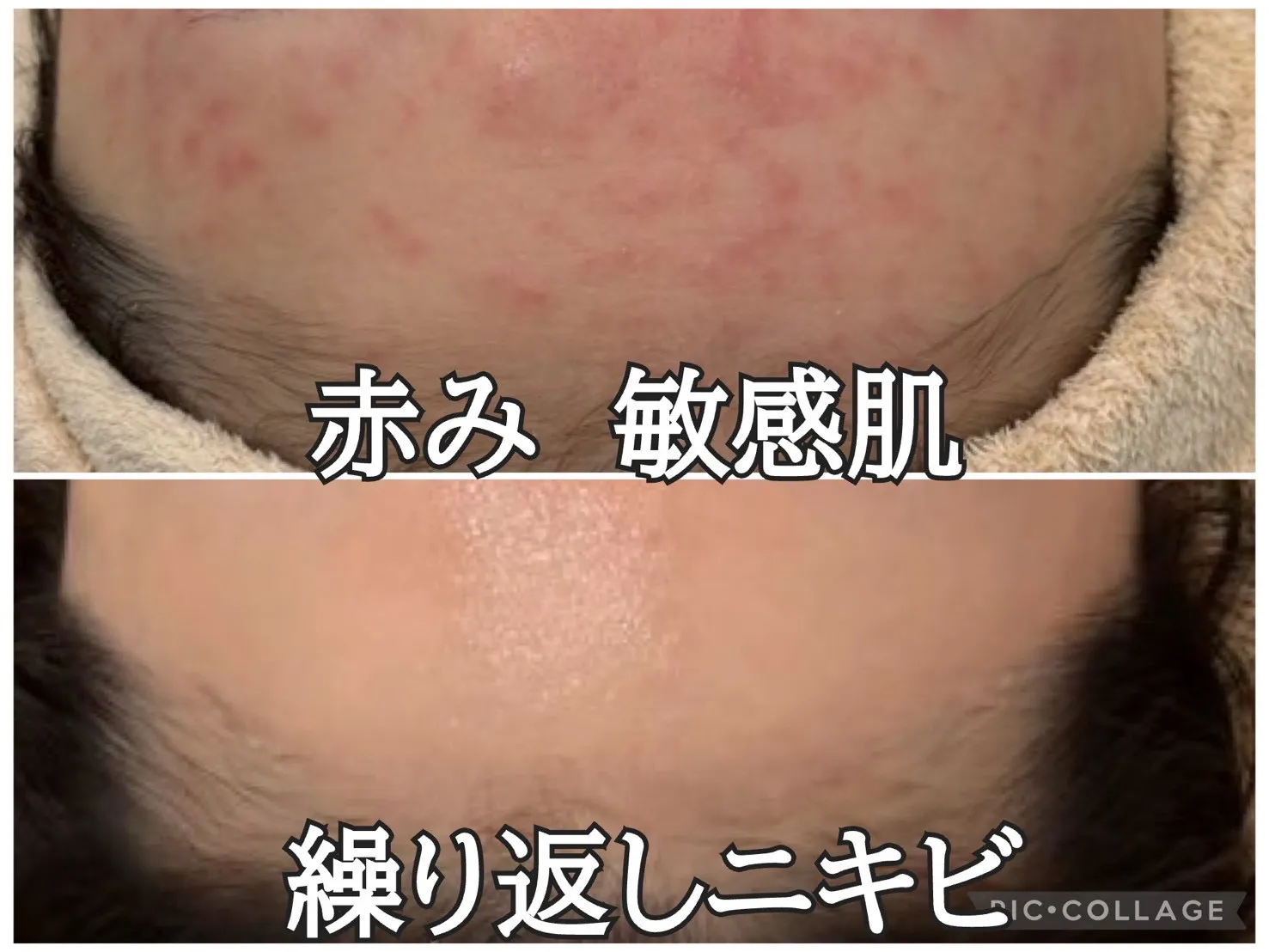 【JR尼崎駅前で肌質改善】敏感肌・妊婦さんの肌荒れも安心◎繰り返すニキビ・赤みを根本ケアする頼れるエステ
