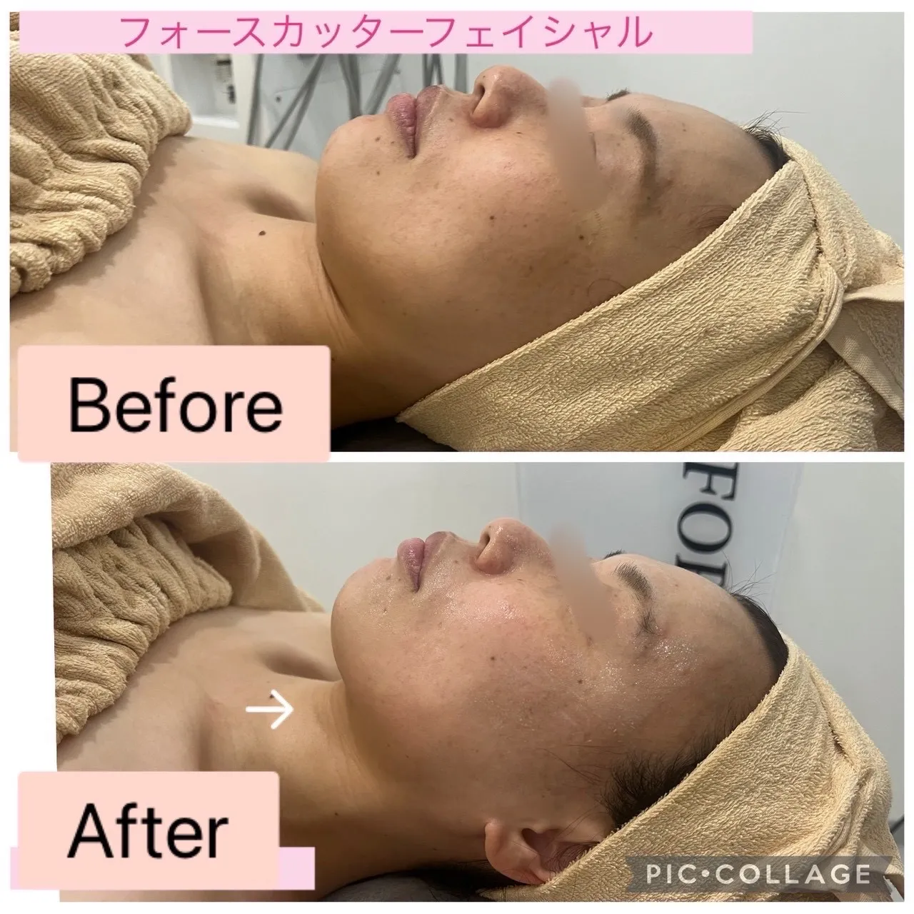 【尼崎で小顔・たるみ改善なら】フォースカッターフェイシャルでスッキリしたフェイスラインへ