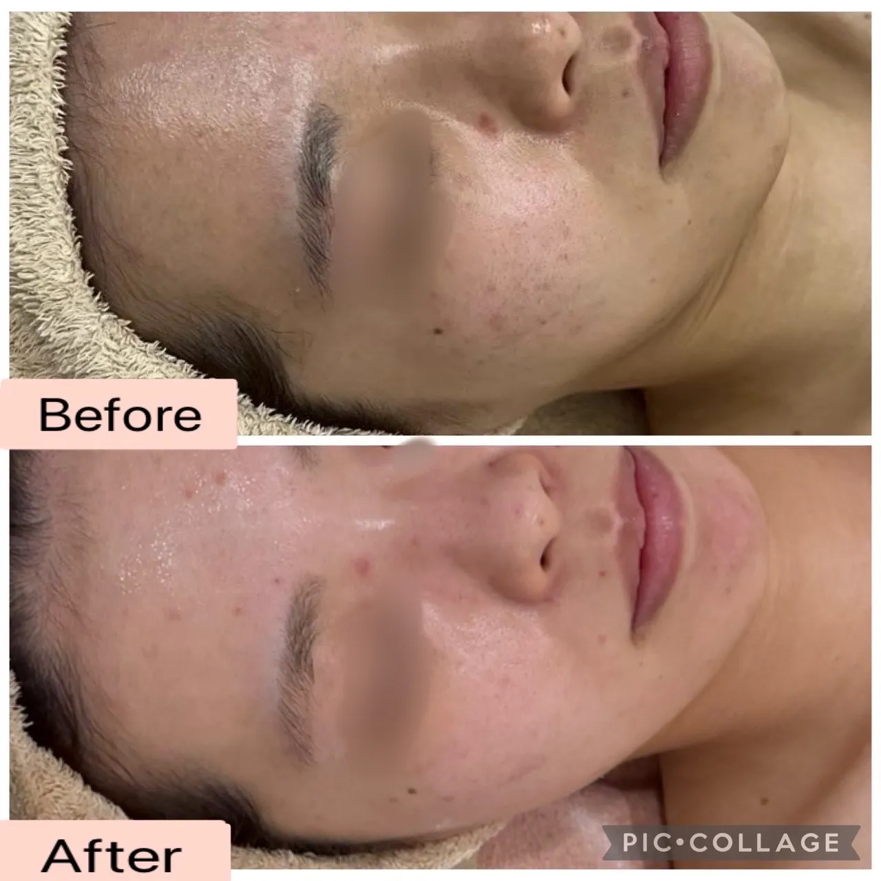 【尼崎】繰り返す肌荒れ・赤み・毛穴にお悩みの方へ｜本気の肌質改善ならRinda Beauty Salonリンダビューティーサロンへ
