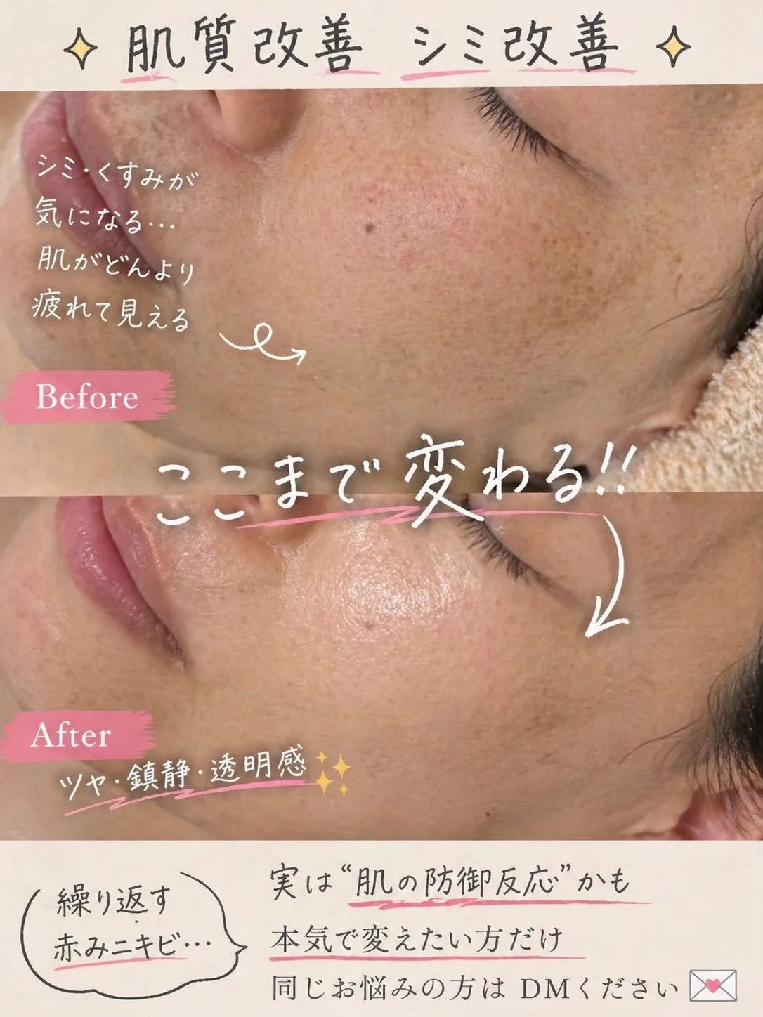 尼崎の肌質改善専門サロン|シミ・赤み・敏感肌・ 毛穴・ニキビ改善なら Rinda Beauty Salonリンダビューティーサロンへ